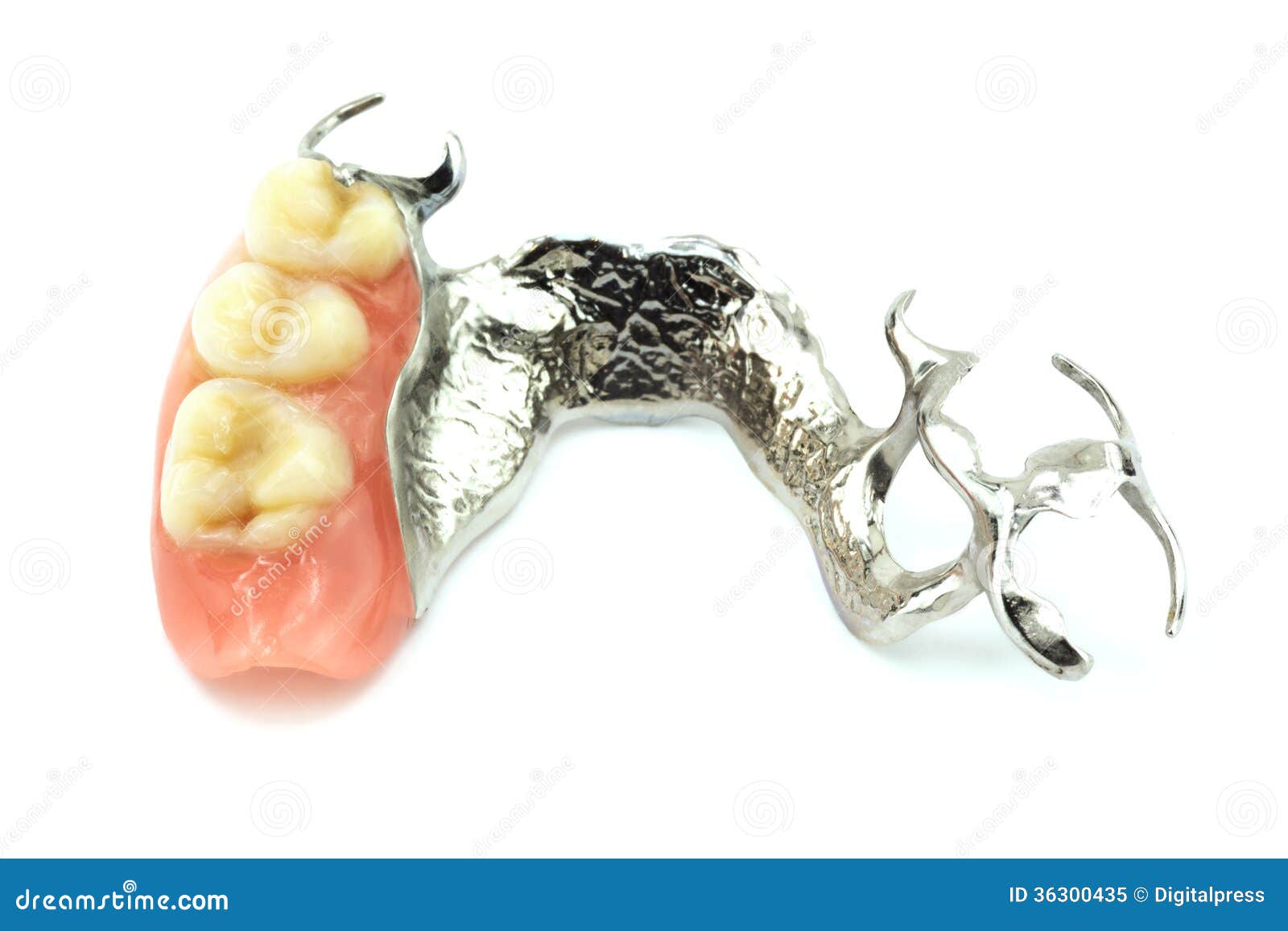 removable partial denture