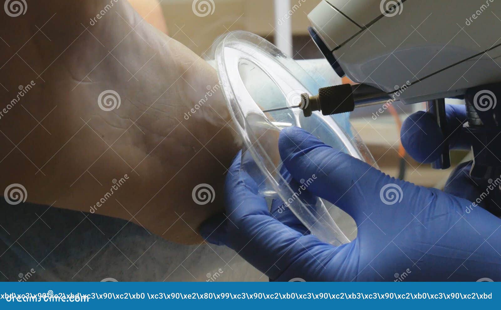 Removal of Corns with Liquid Nitrogen Stock Video Video of pedicurist