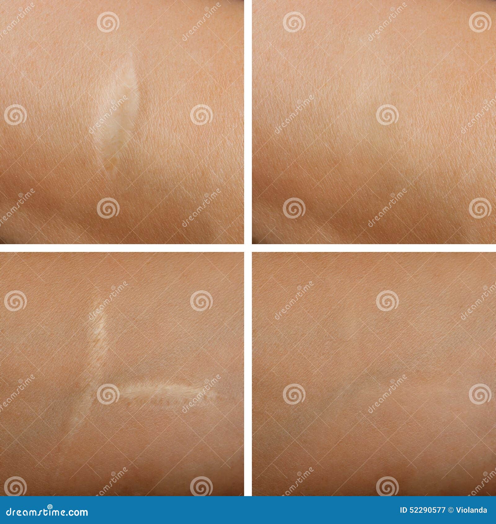 Removal of Scars on the Skin Stock Image Image of stomach, healthcare