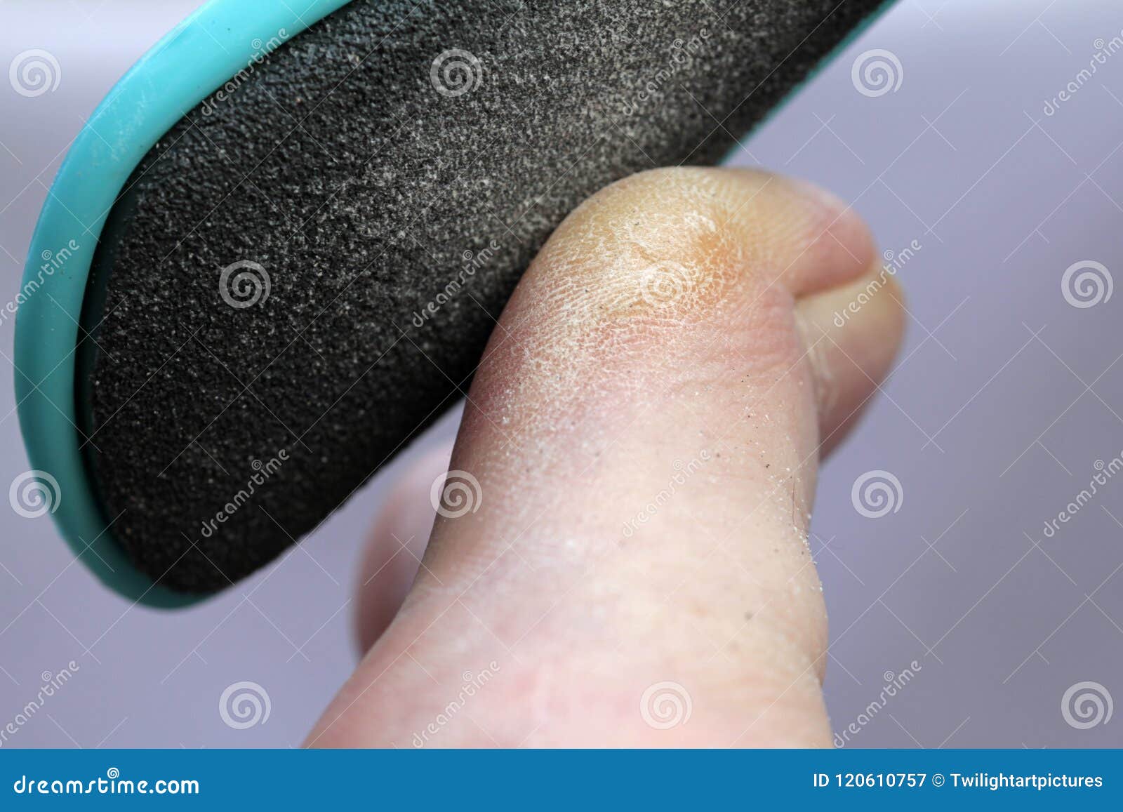 Thickened Toenail Stock Photos - Free & Royalty-Free Stock Photos from  Dreamstime