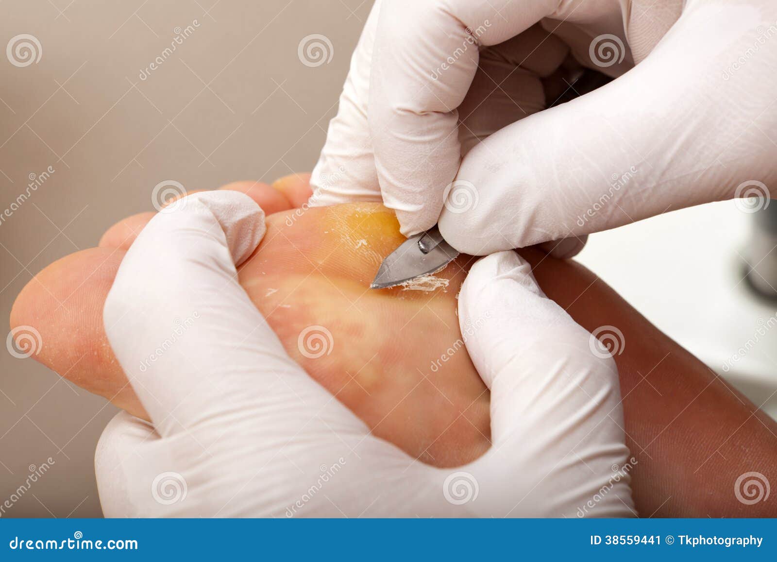 Picture of Viral Skin Diseases and Problems - Warts (Human ...