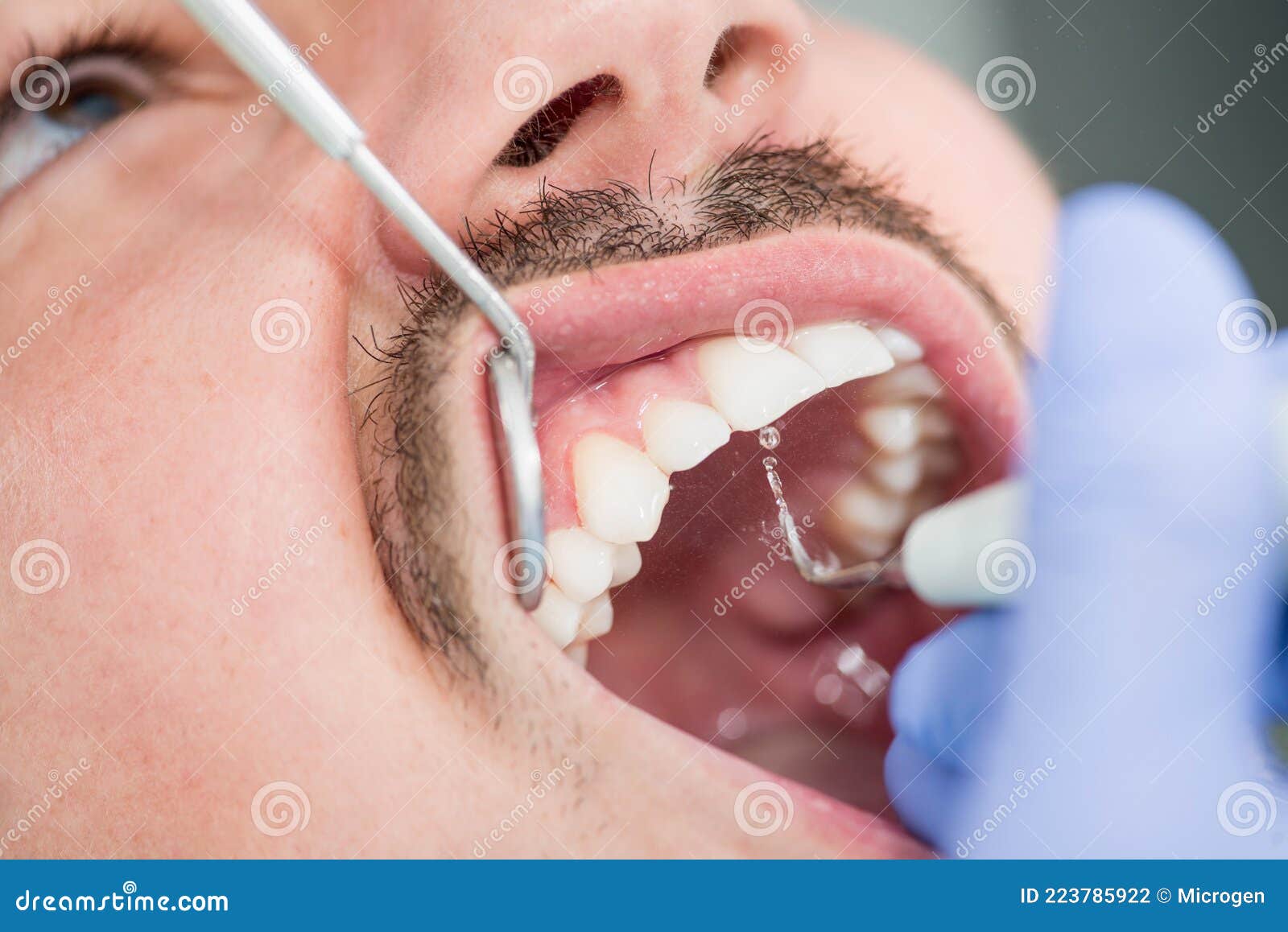 Removing plaque stock photo. Image of calculus, dentist 223785922