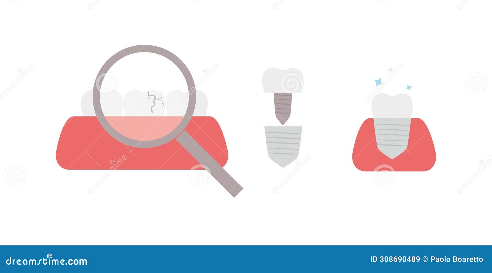 Replacement of Broken Tooth with Dental Cap Stock Illustration