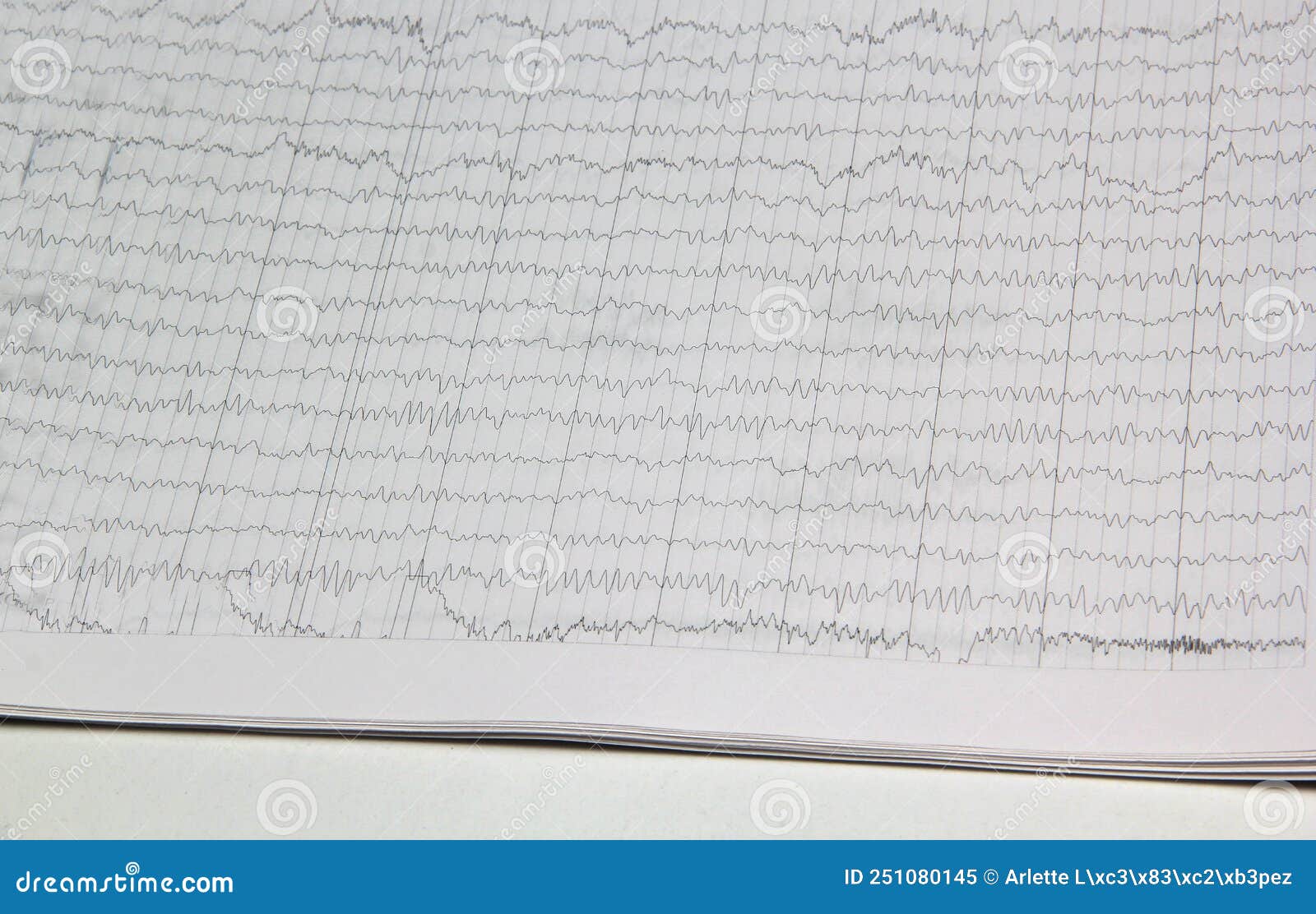 Results of an Electroencephalogram after a Neurophysiological