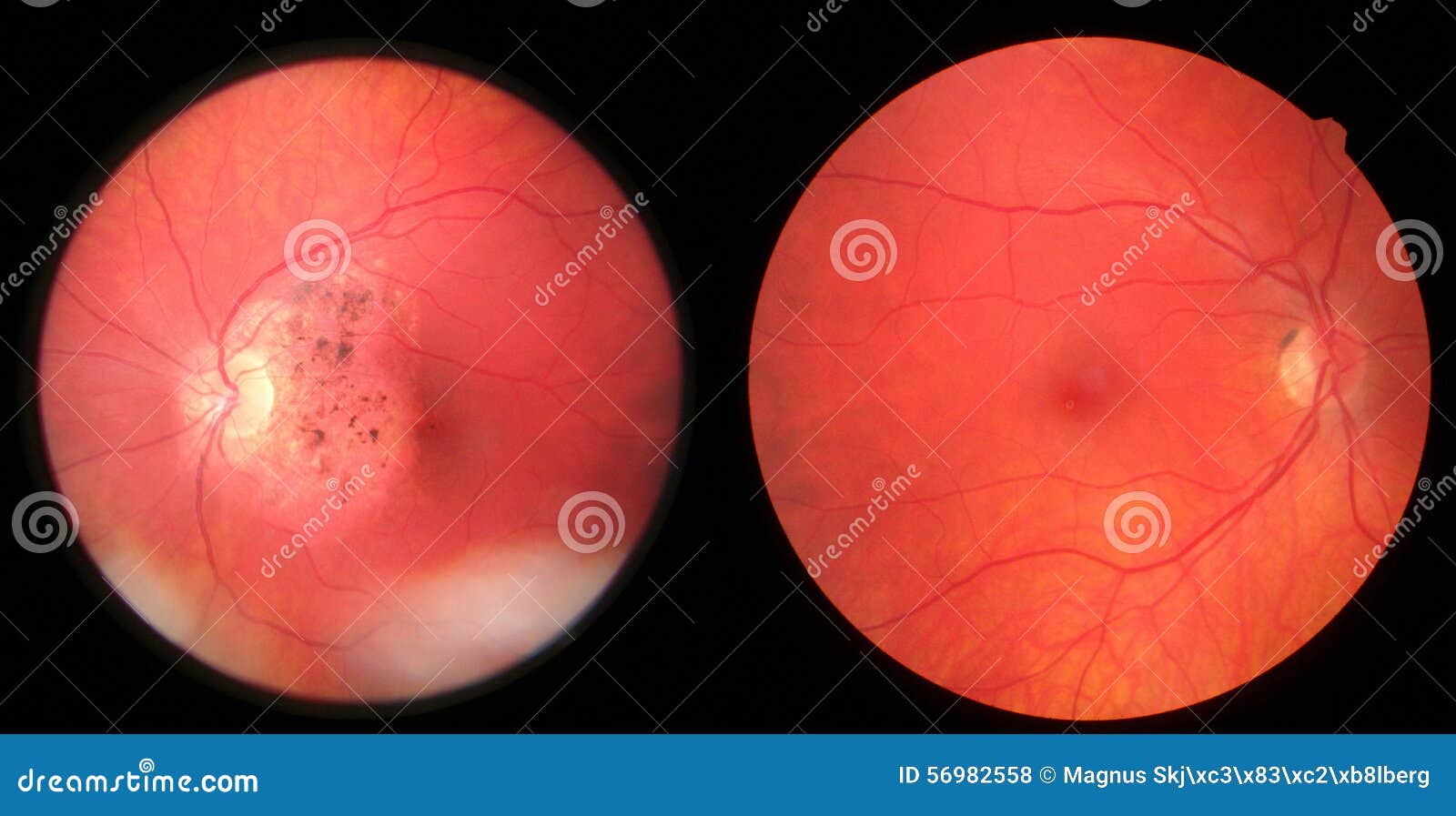 retina - damaged and healthy