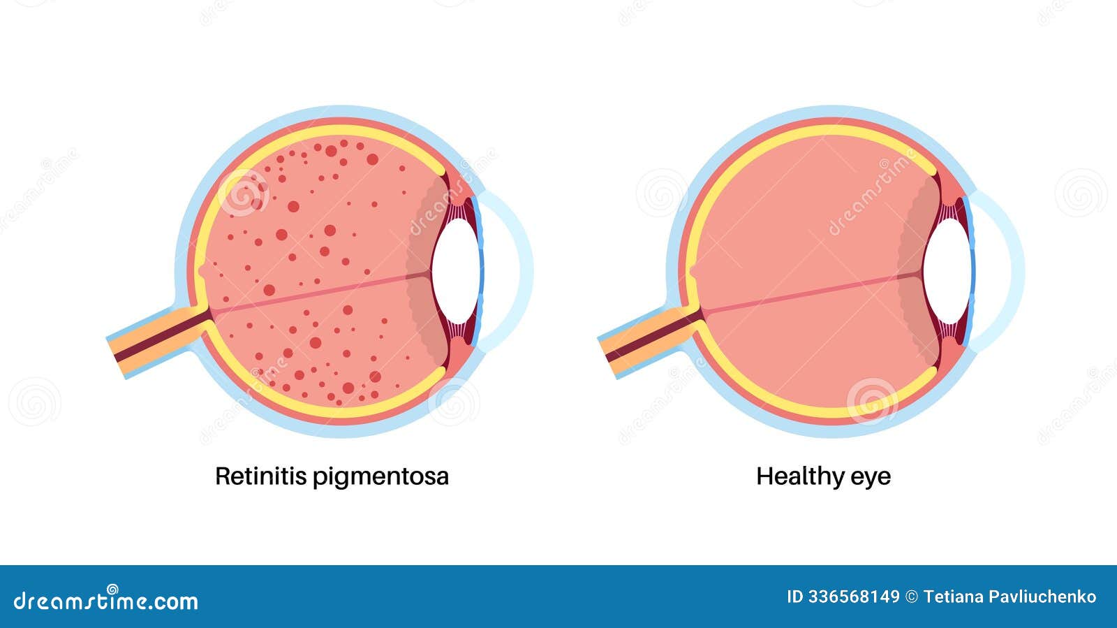 retinitis pigmentosa poster