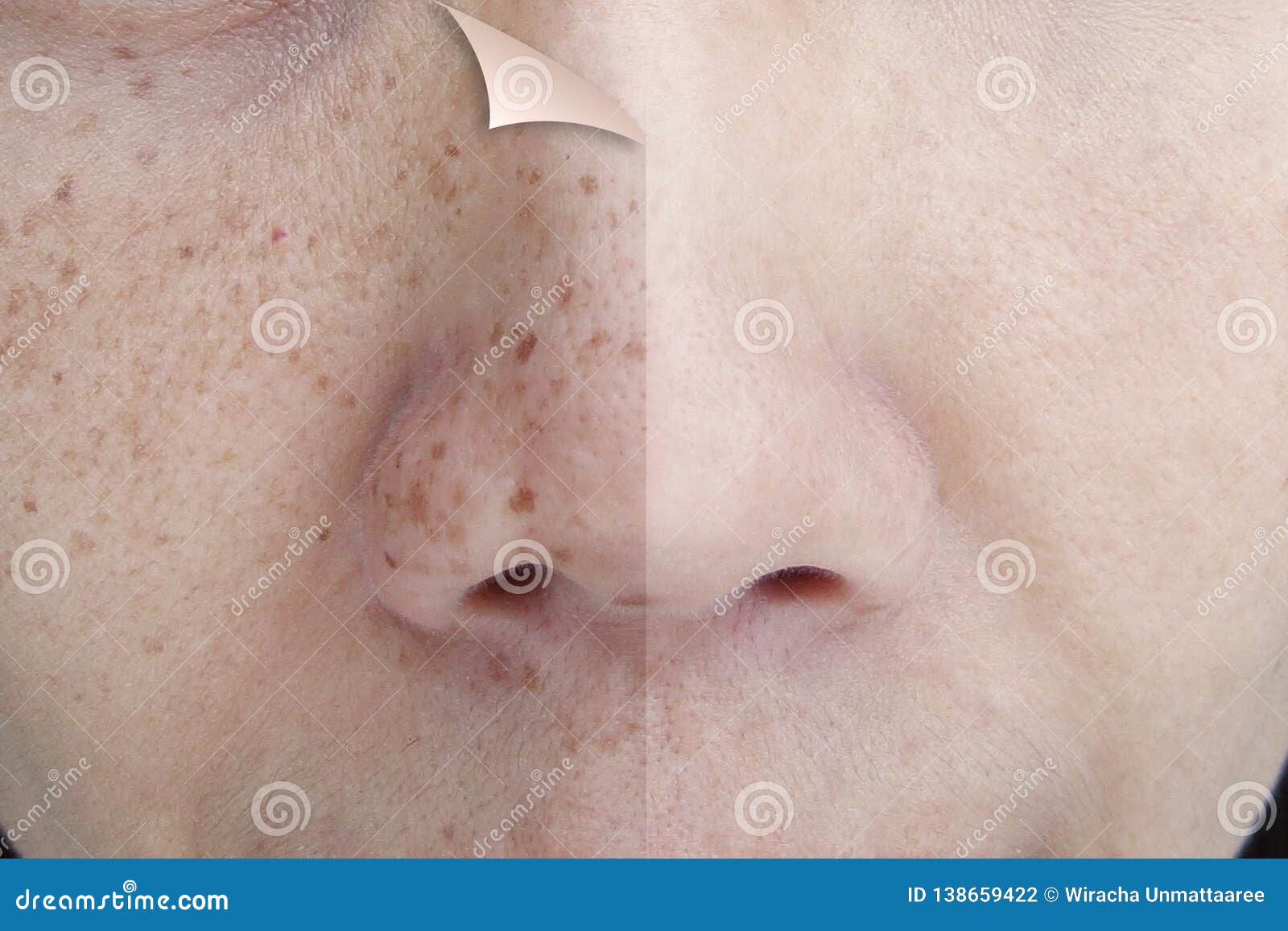 before and after retouch freckles on young asian woman face
