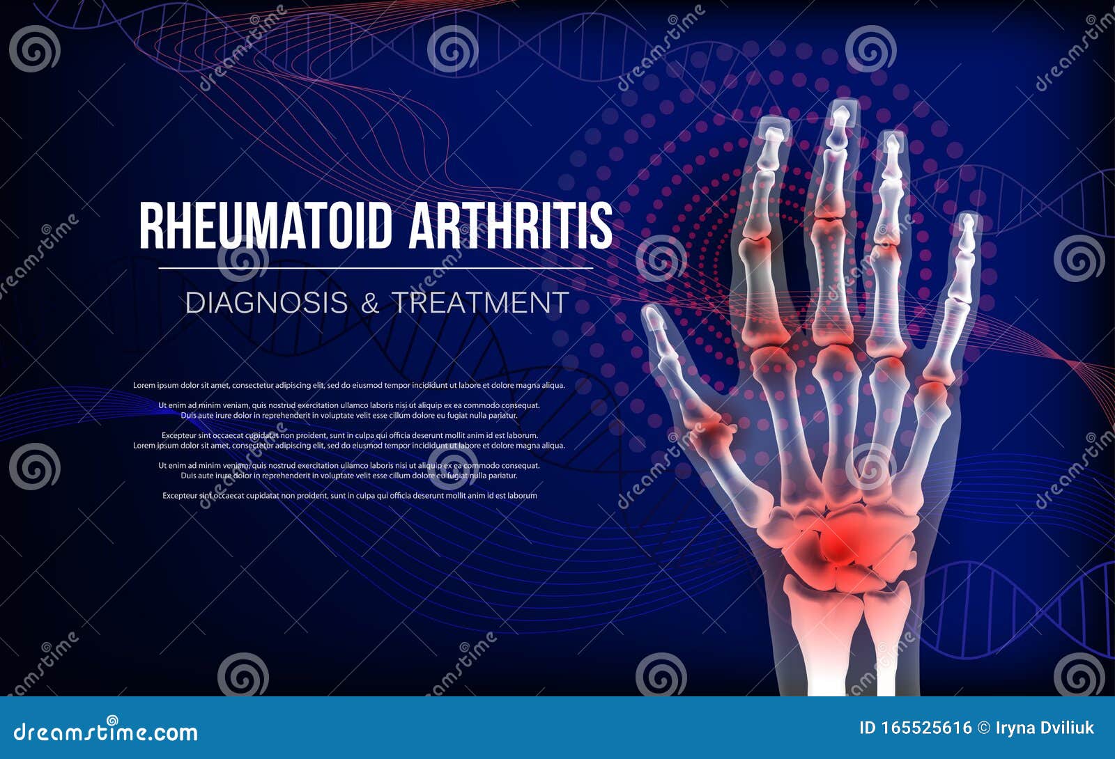Reumatoid Artrit Osteoartrit Banderoller Inflammationer I Skelettbenen Vektor Illustrationer - av baner: 165525616