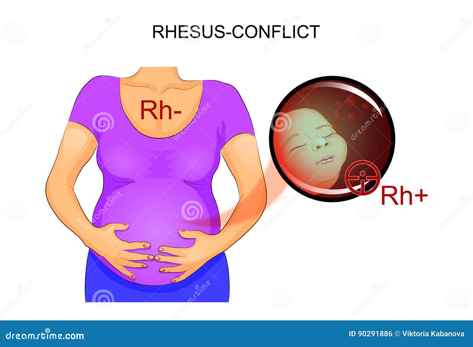 Rh Negative Pregnancy Stock Illustrations 2 Rh Negative Pregnancy Stock Illustrations Vectors Clipart Dreamstime Rh Negative Pregnancy Stock Illustrations 2 Rh Negative Pregnancy Stock Illustrations Vectors Clipart Dreamstime