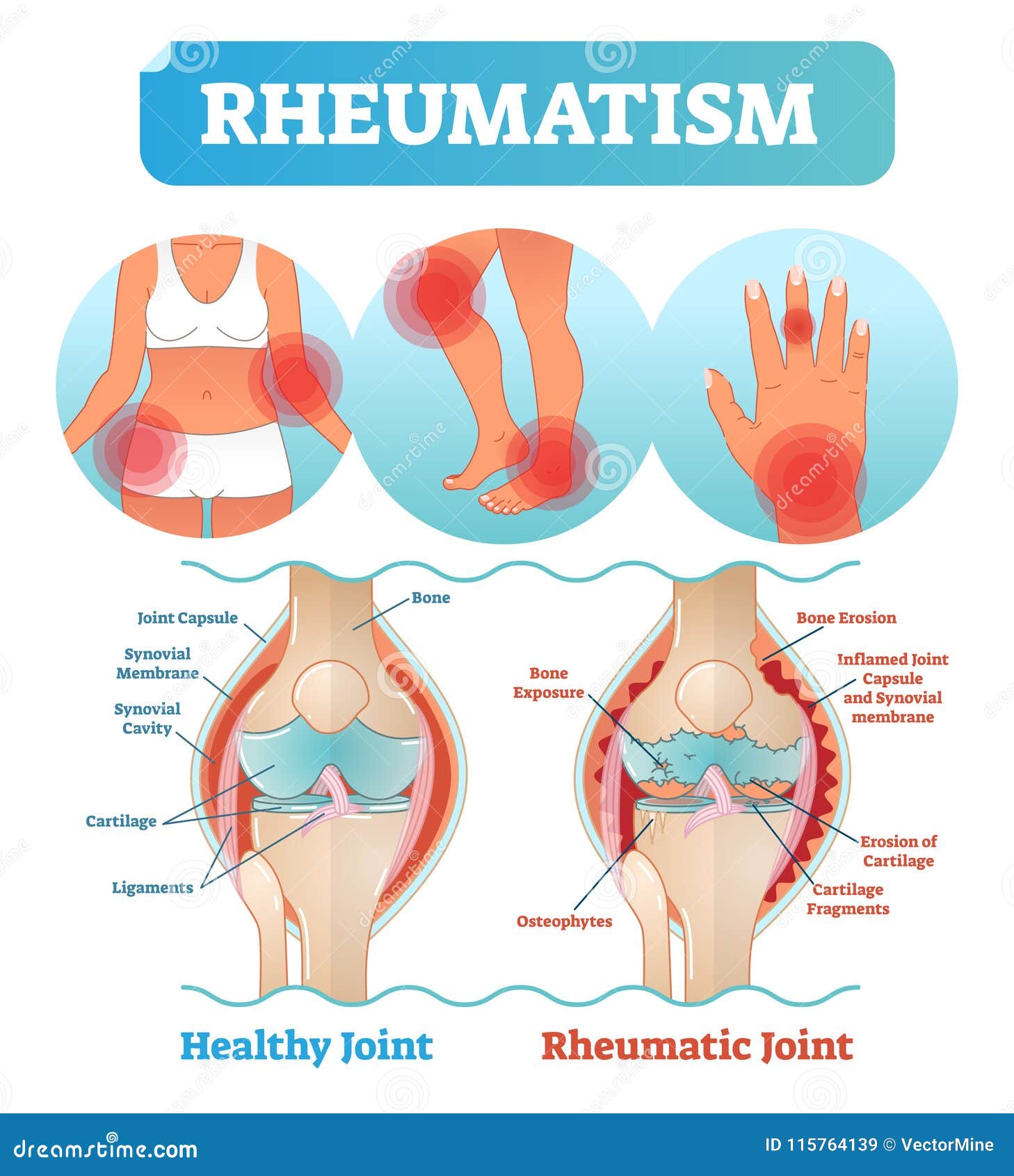 Rheumatism Medical Health Care Vector Illustration Poster