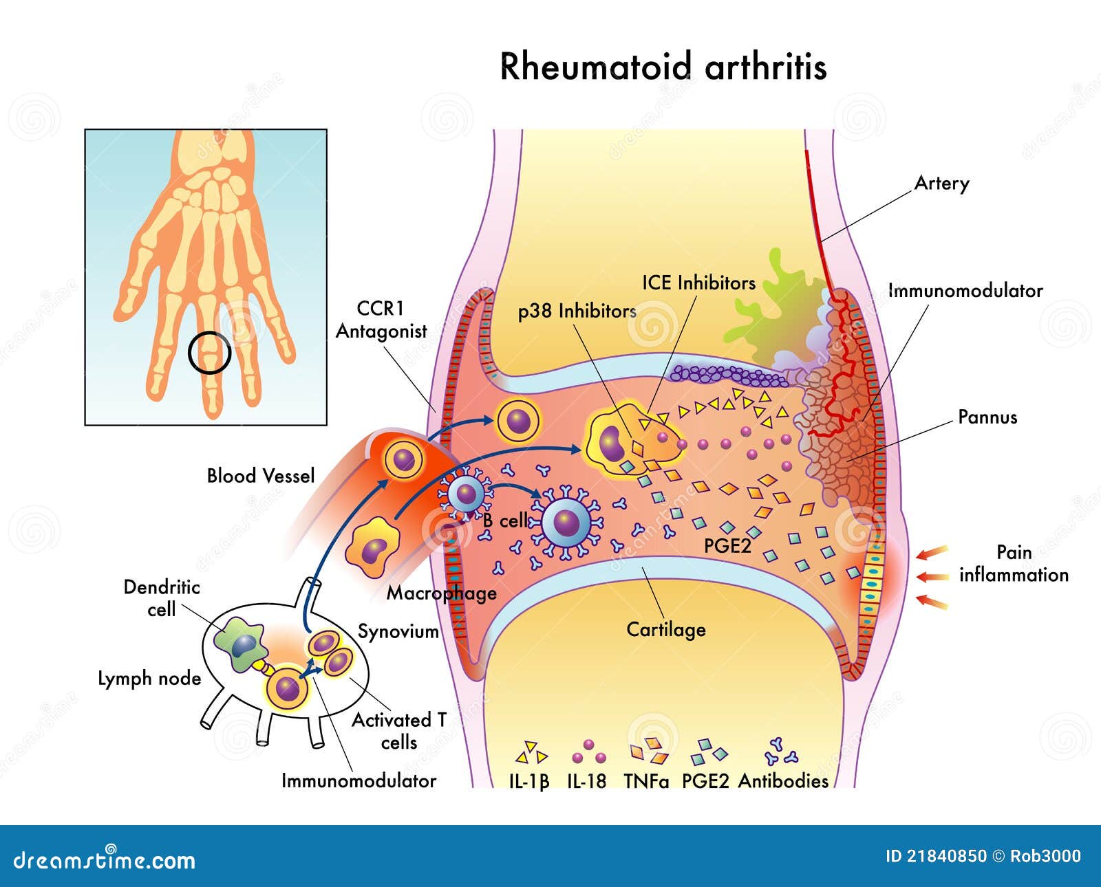 korai stádiumú rheumatoid arthritis a nyaki gerinc intervertebrális osteochondrosisa