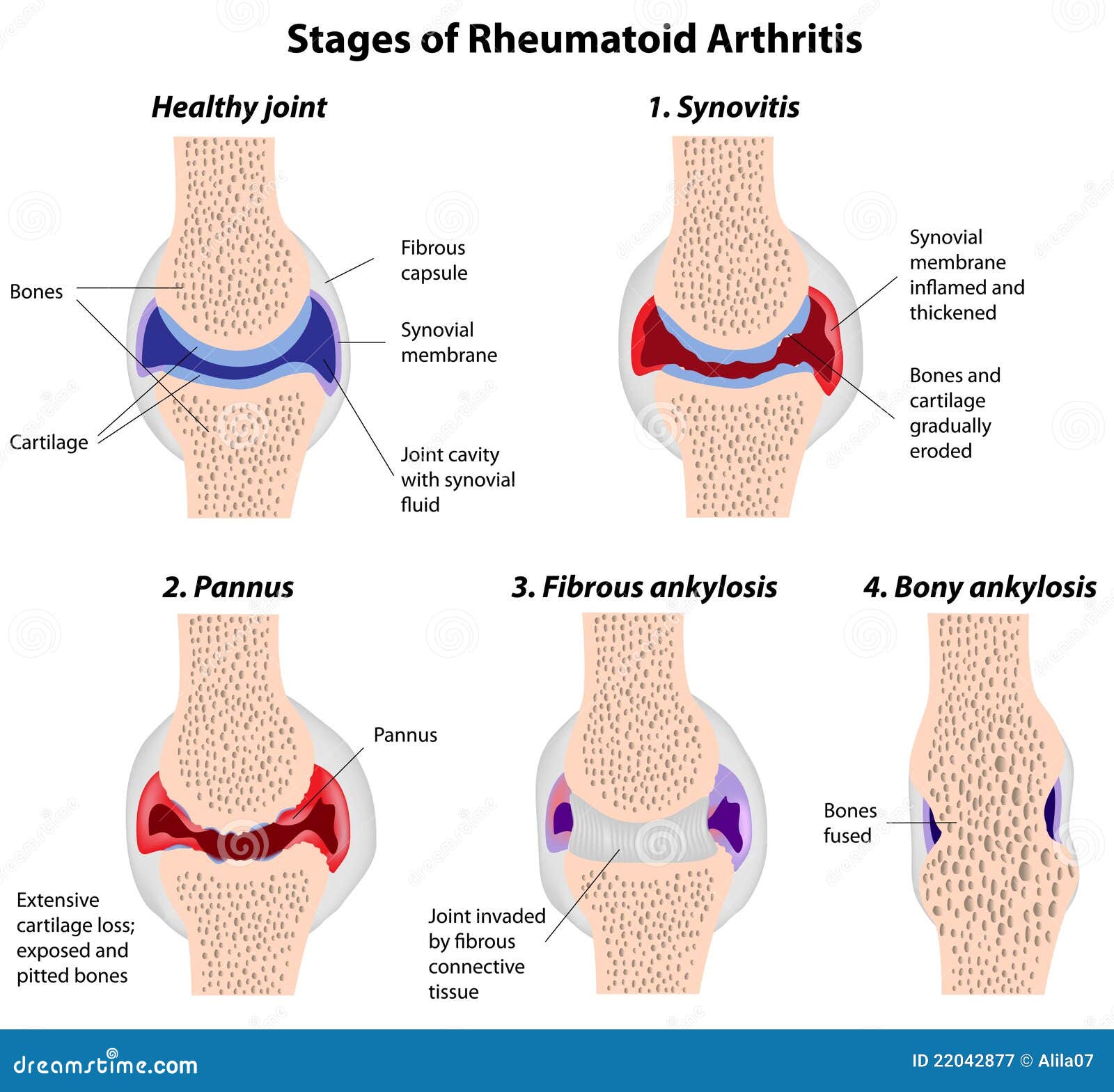 térdkezelési előrejelzés osteoarthritis duzzadt láb kezelése