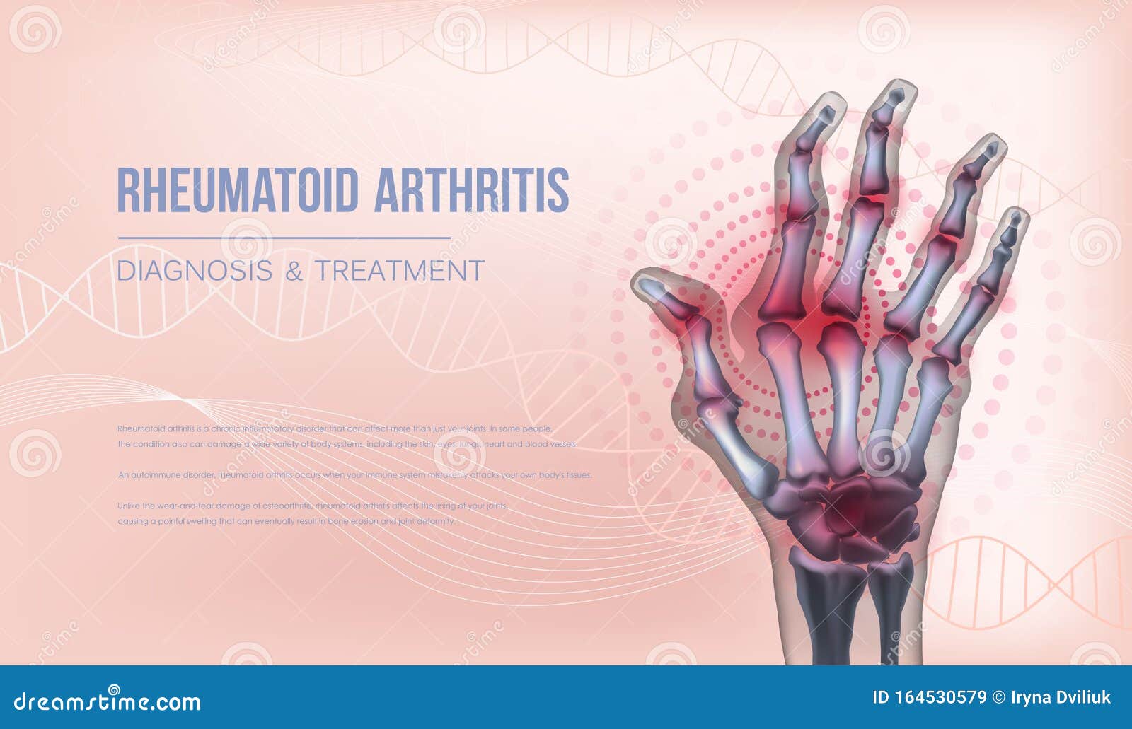 rheumatoid arthritis banner hand joints deformation.