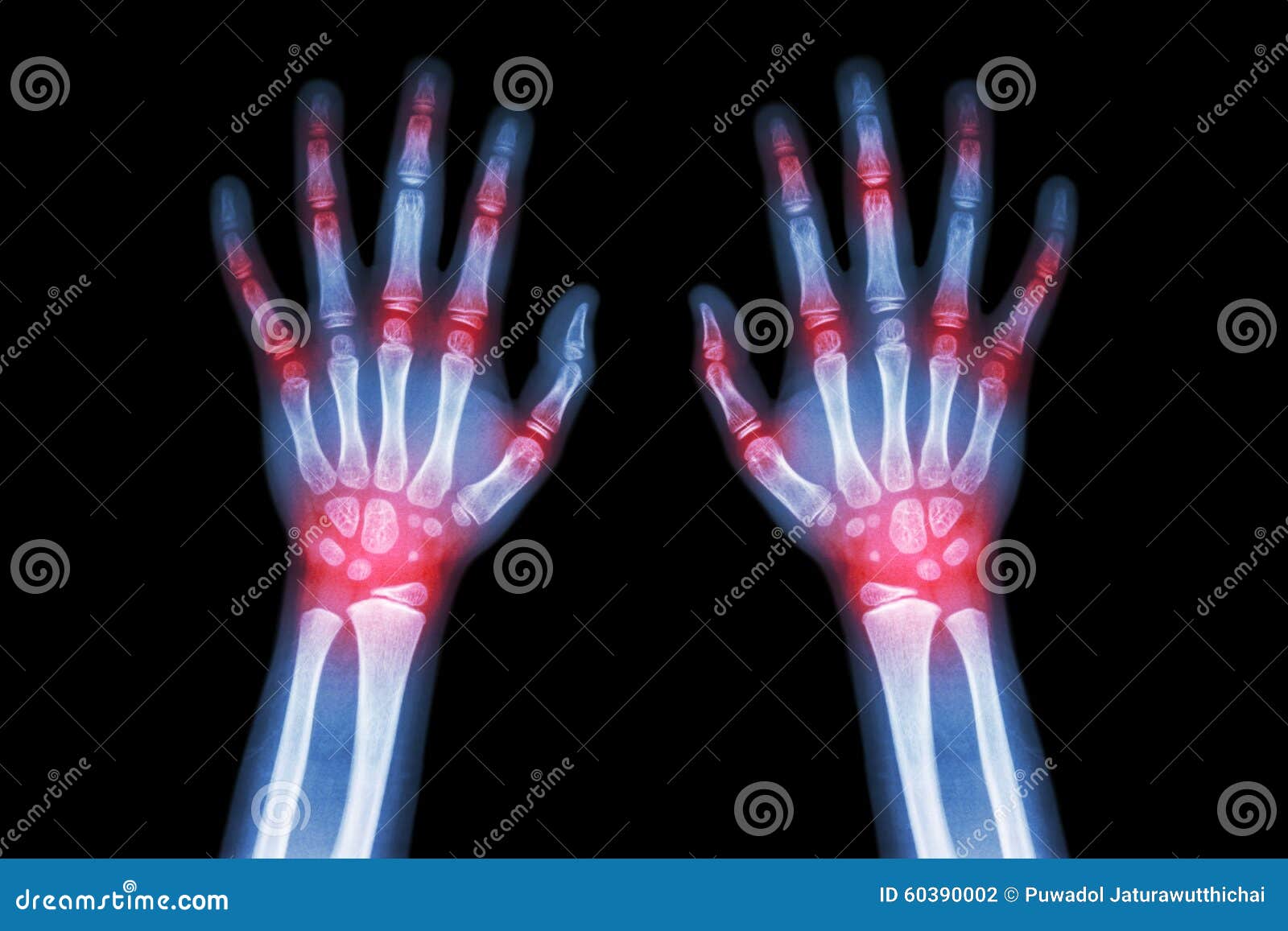 rheumatoid arthritis , gout arthritis ( film x-ray both hands of child with multiple joint arthritis ) ( medical , science and he