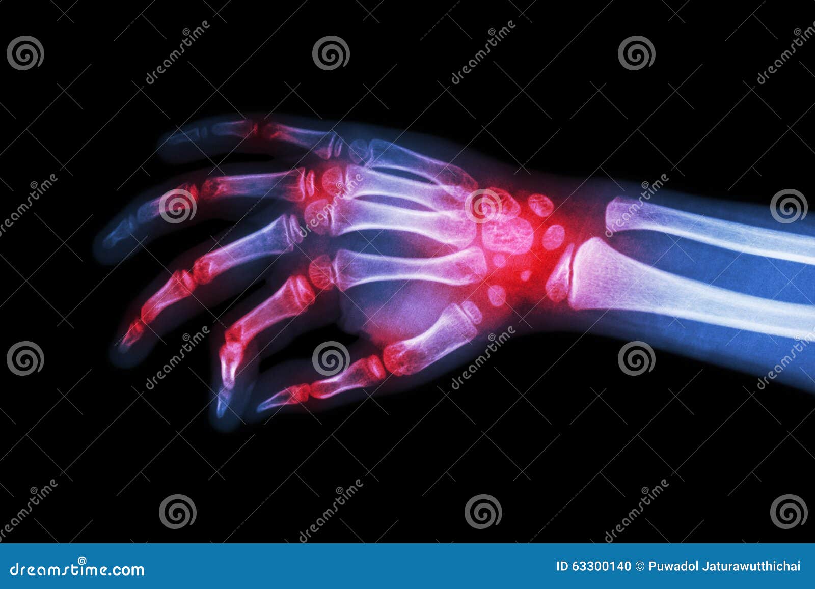 rheumatoid arthritis , gouty arthritis ( film x-ray hand of child with arthritis at multiple joint )