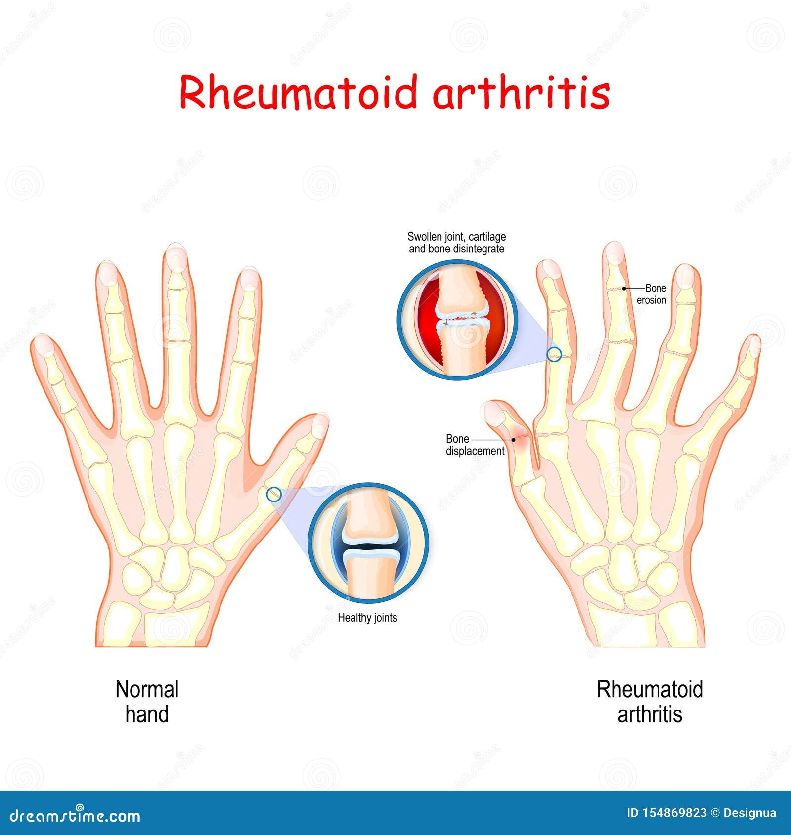 Hand Anatomy Arthritis