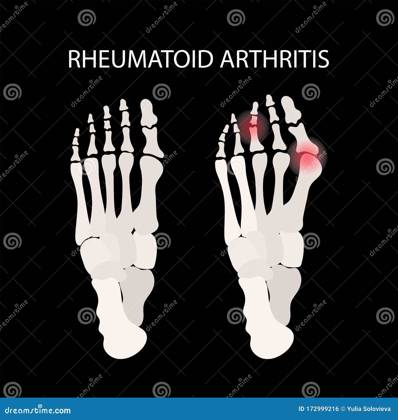 rheumatoid artritis leg medicine education  scheme