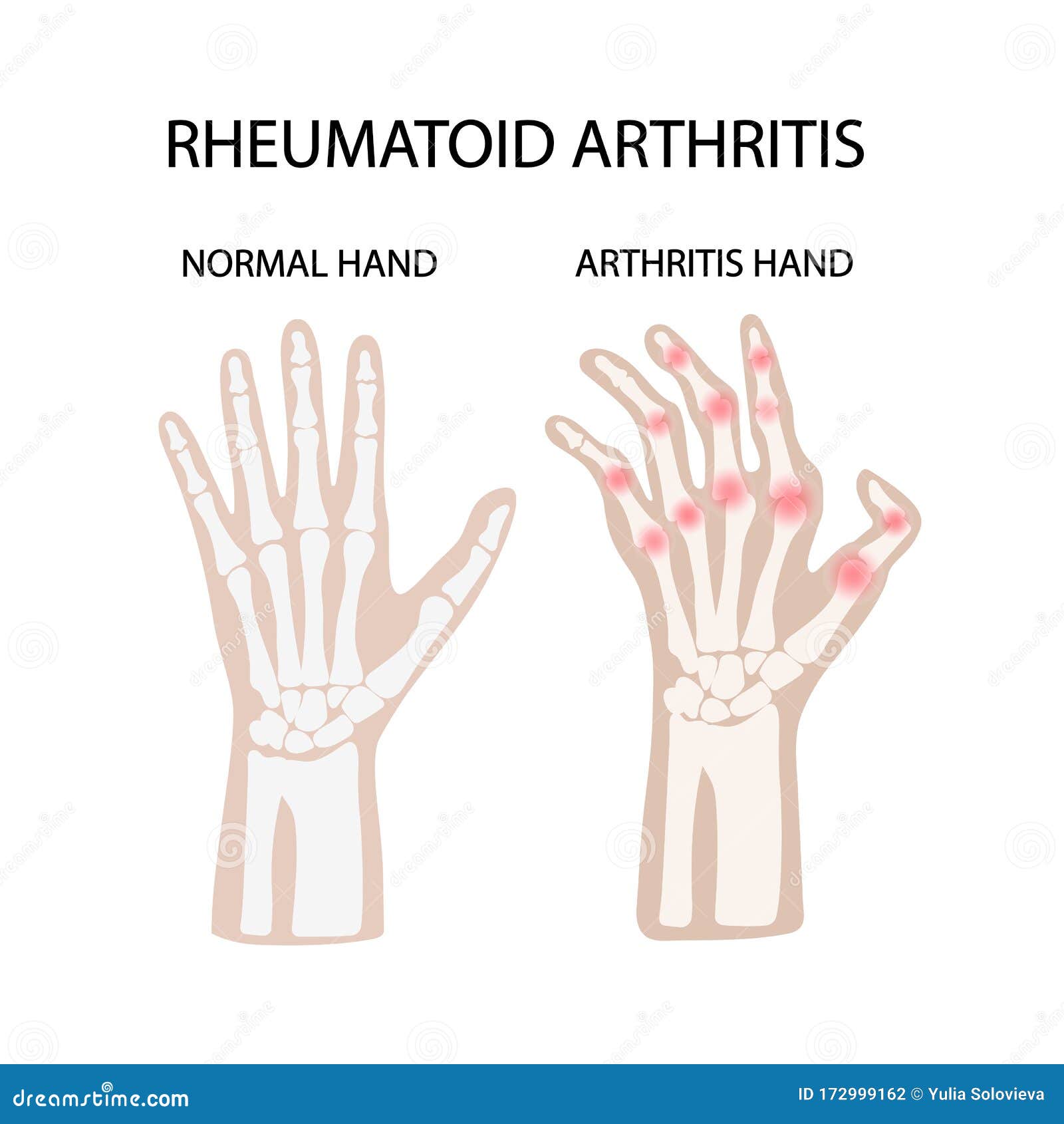 rheumatoid artritis white medicine education  scheme