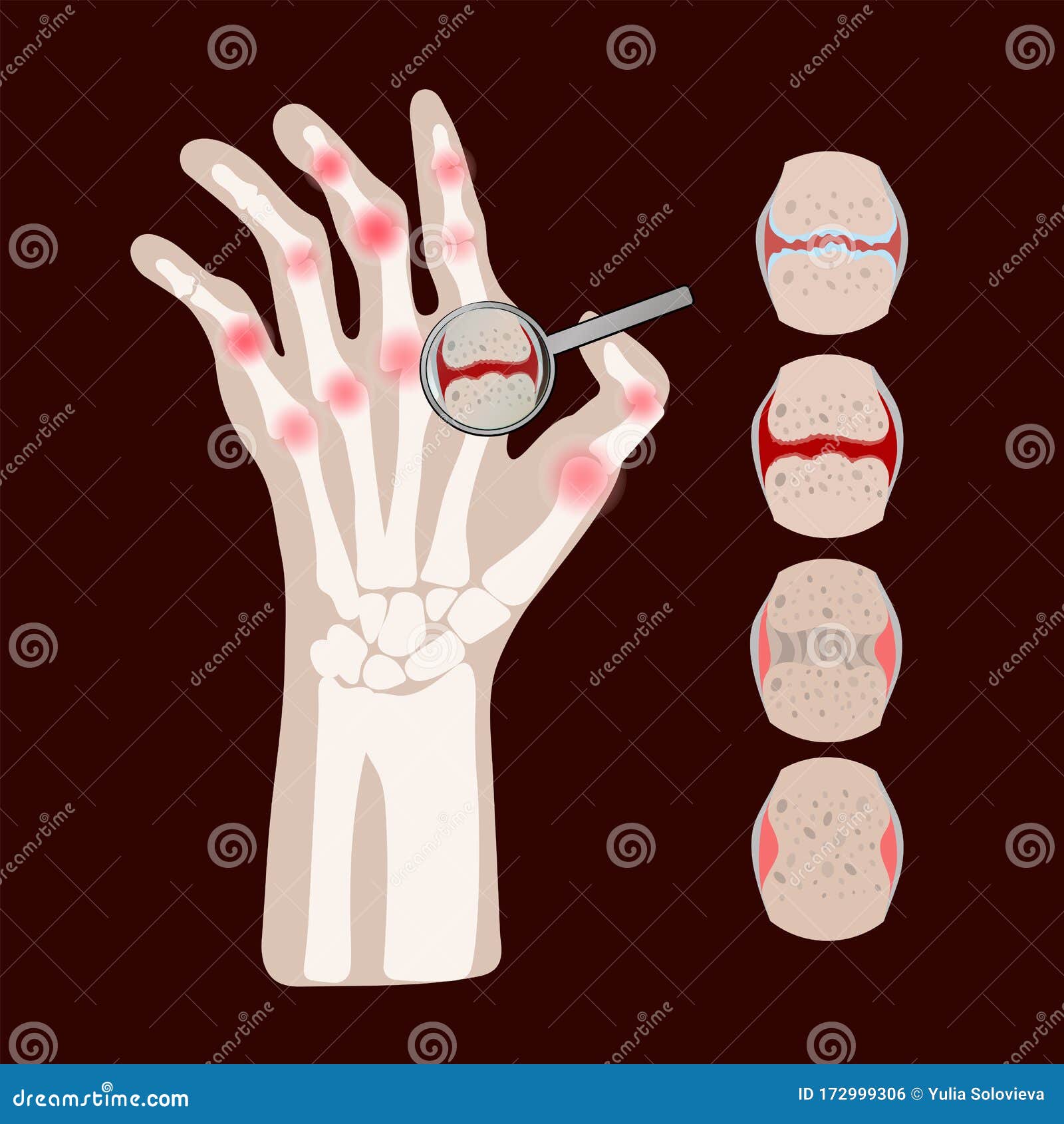 rheumatoid disease artritis medicine education  scheme