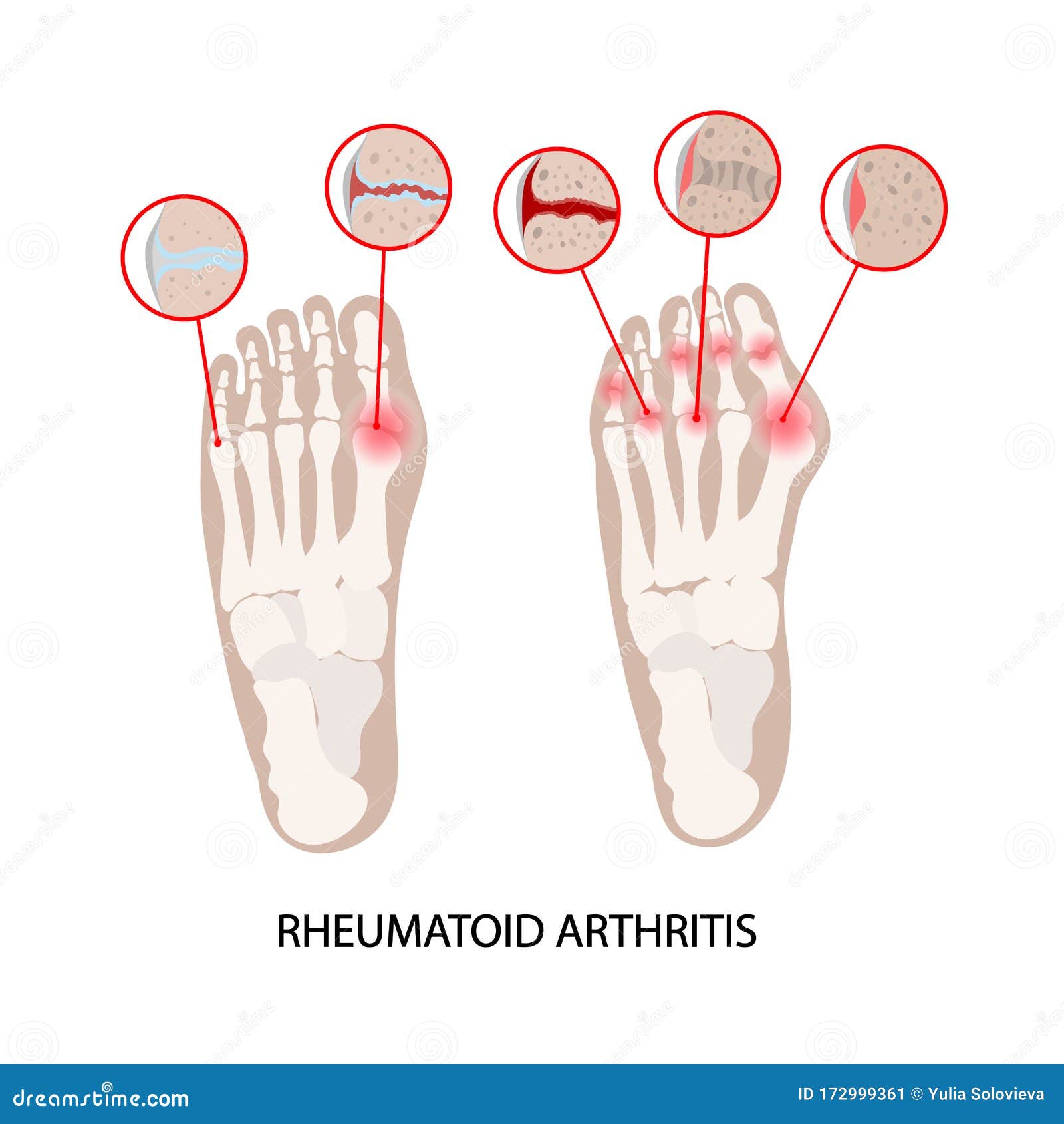 rheumatoid disease leg artritis medicine education scheme