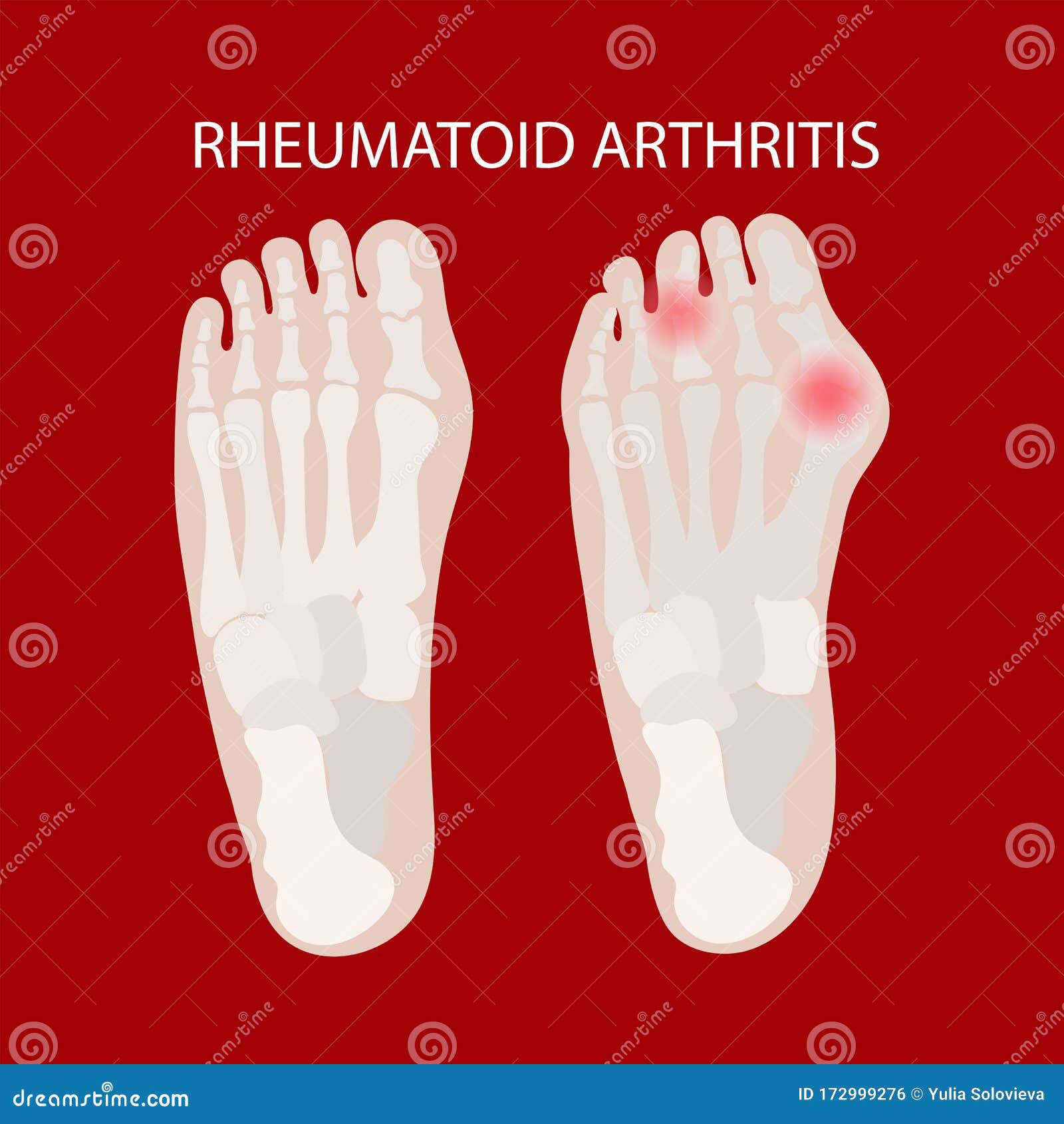 rheumatoid leg artritis medicine education scheme 