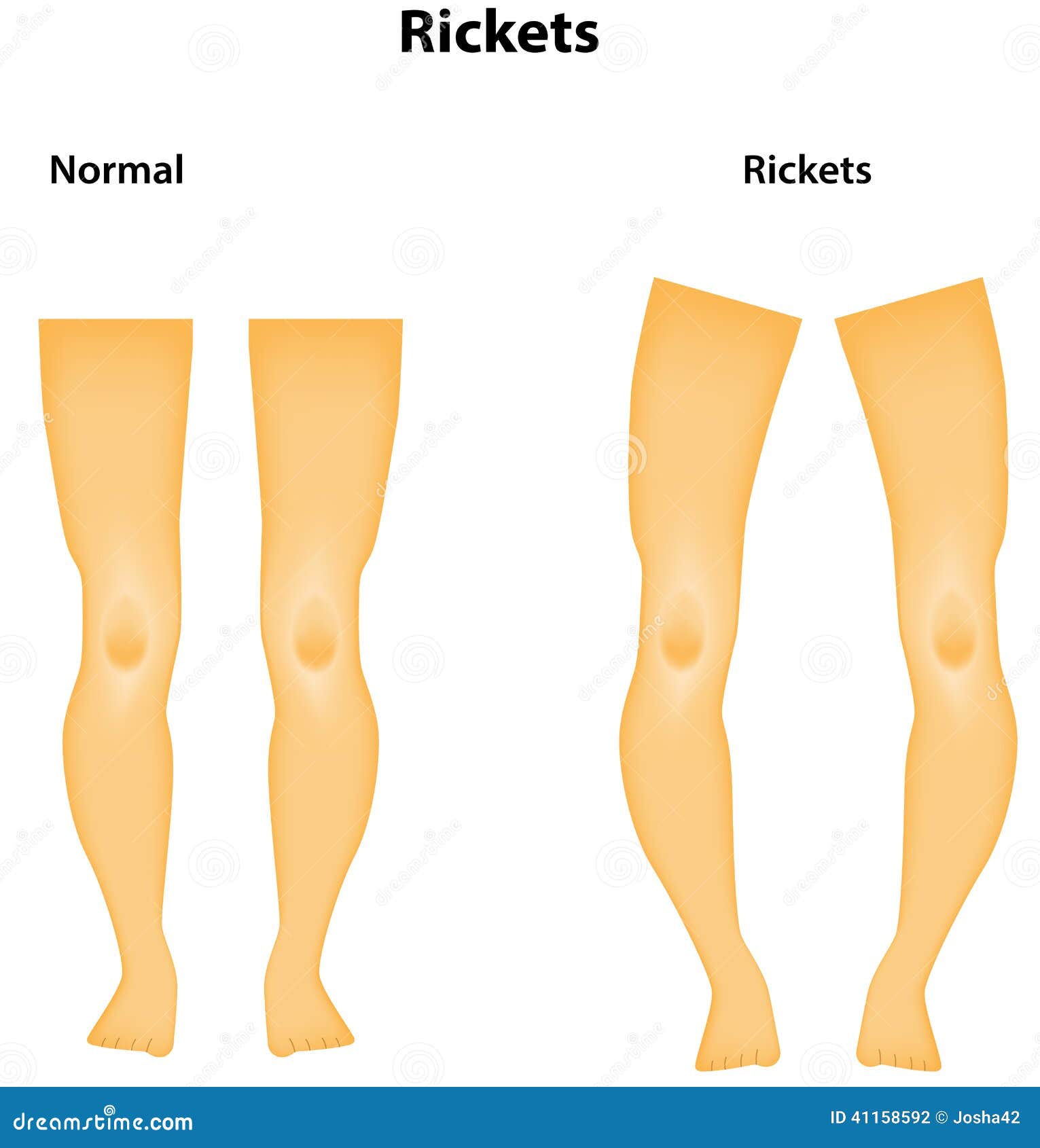 Rickets or abuse? a histologic comparison of rickets and 