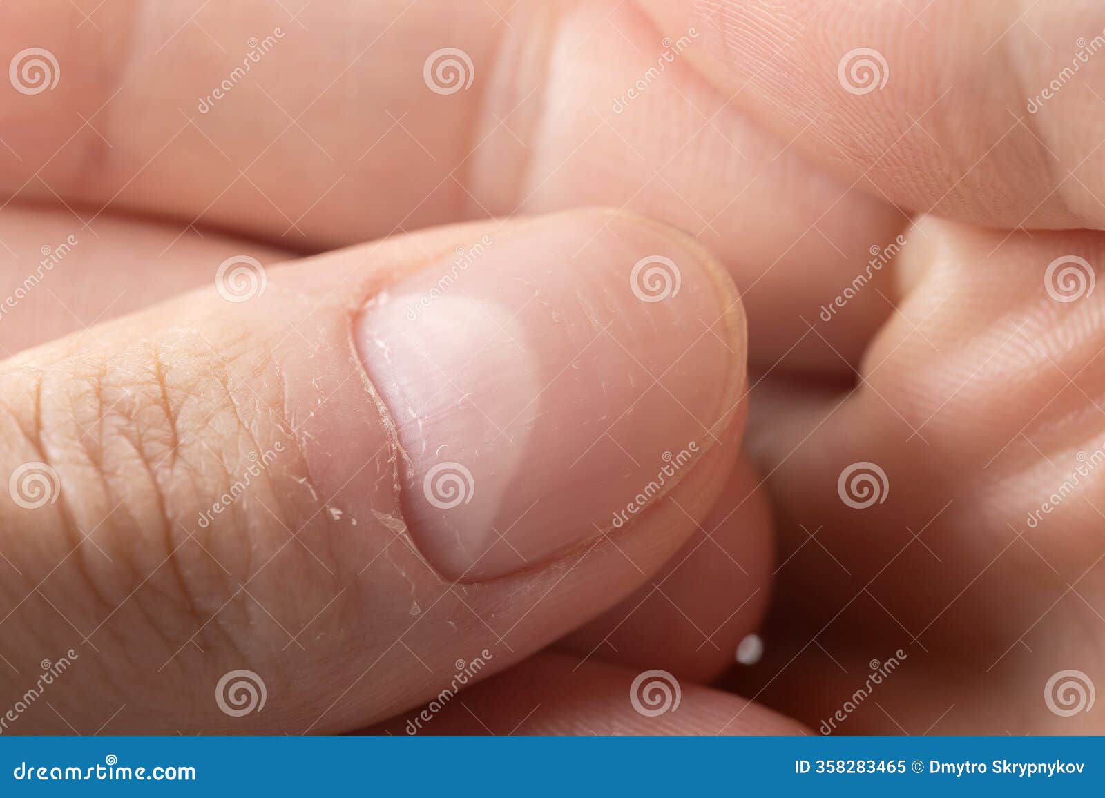 What Exactly Are Beau's Lines on Nails?, image size:1600x1156