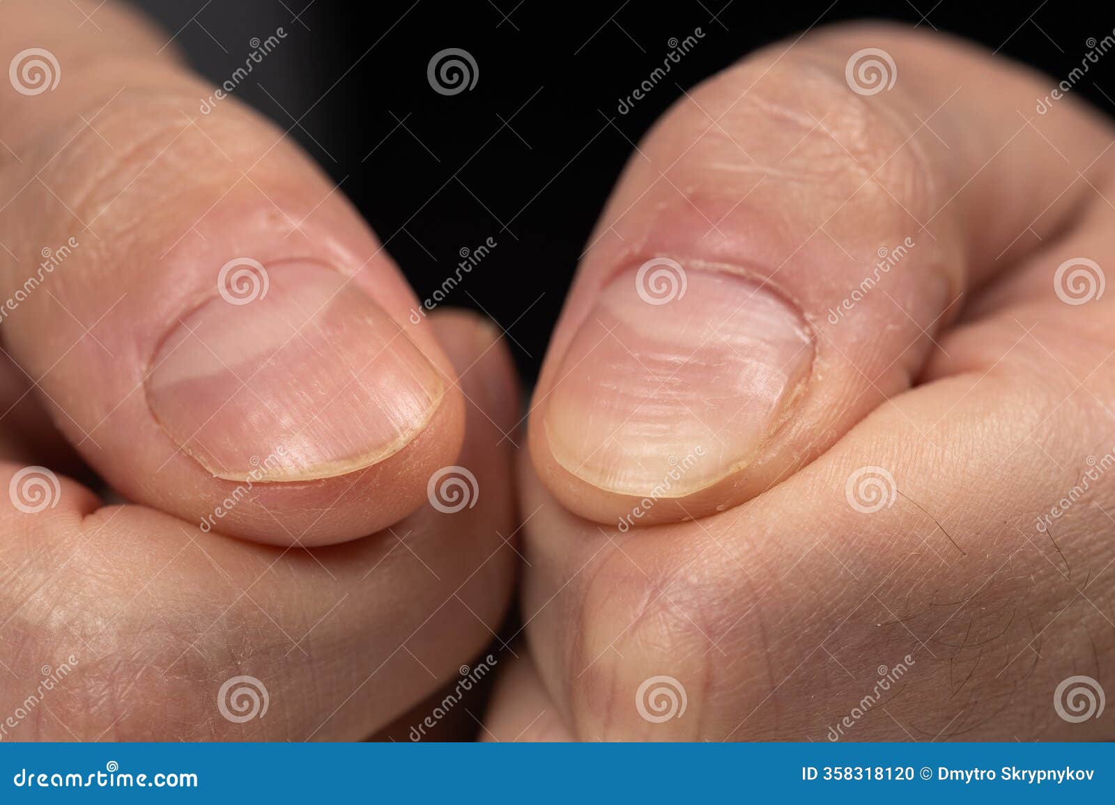 Nail Ridges Horizontal Stock Photos - Free \u0026 Royalty-Free Stock Photos from  Dreamstime, image size:1600x1156