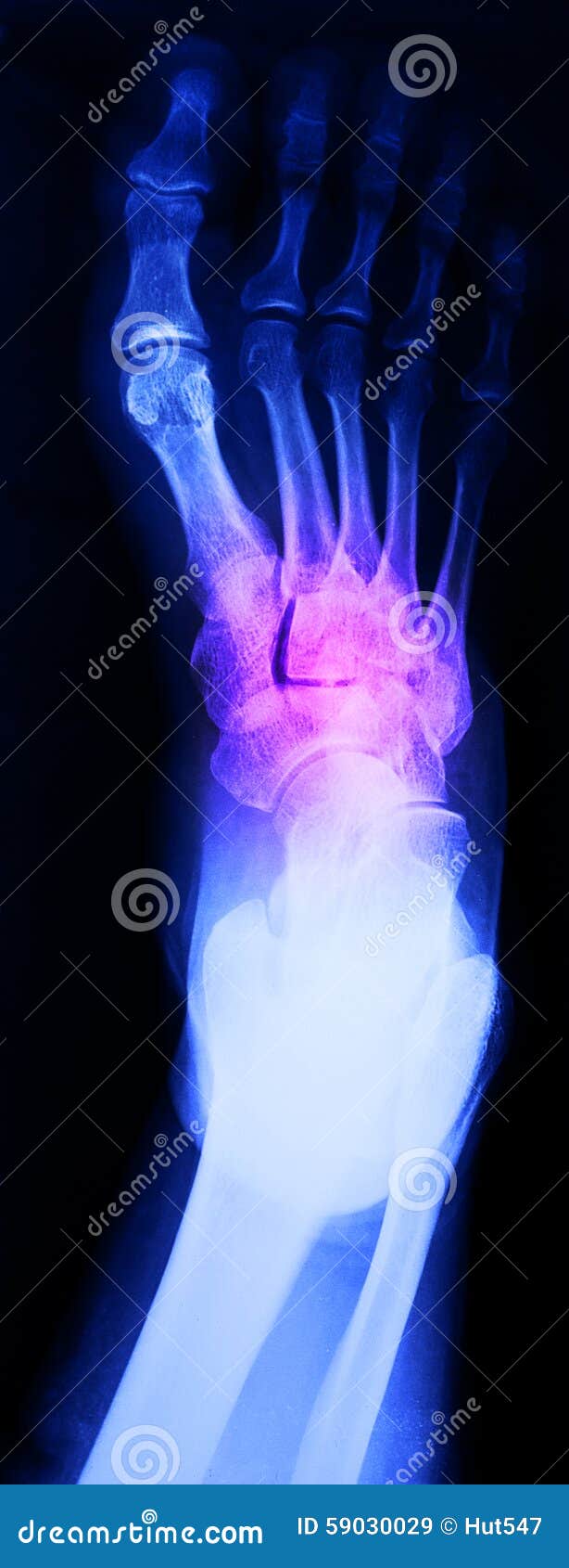 Right foot ankle Xray stock image. Image of patient, anatomy 59030029