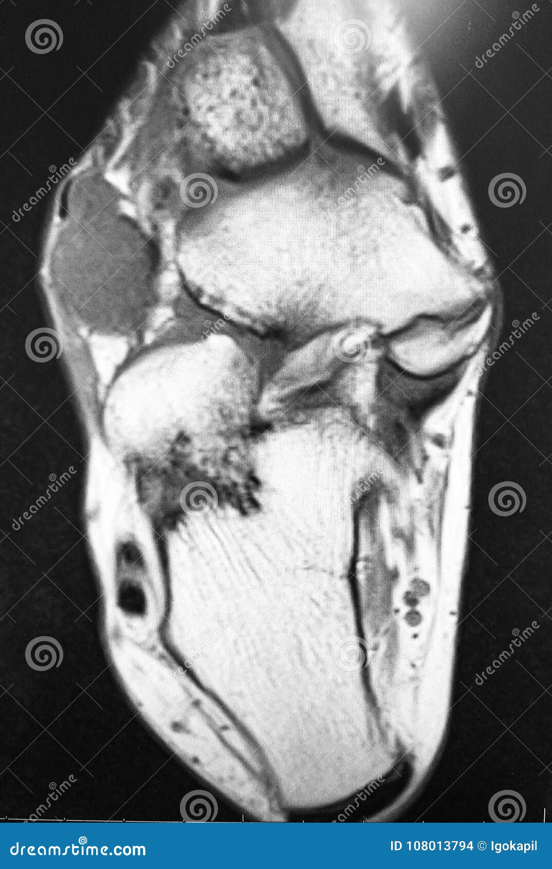 right foot dorsal aspect mass mri exam