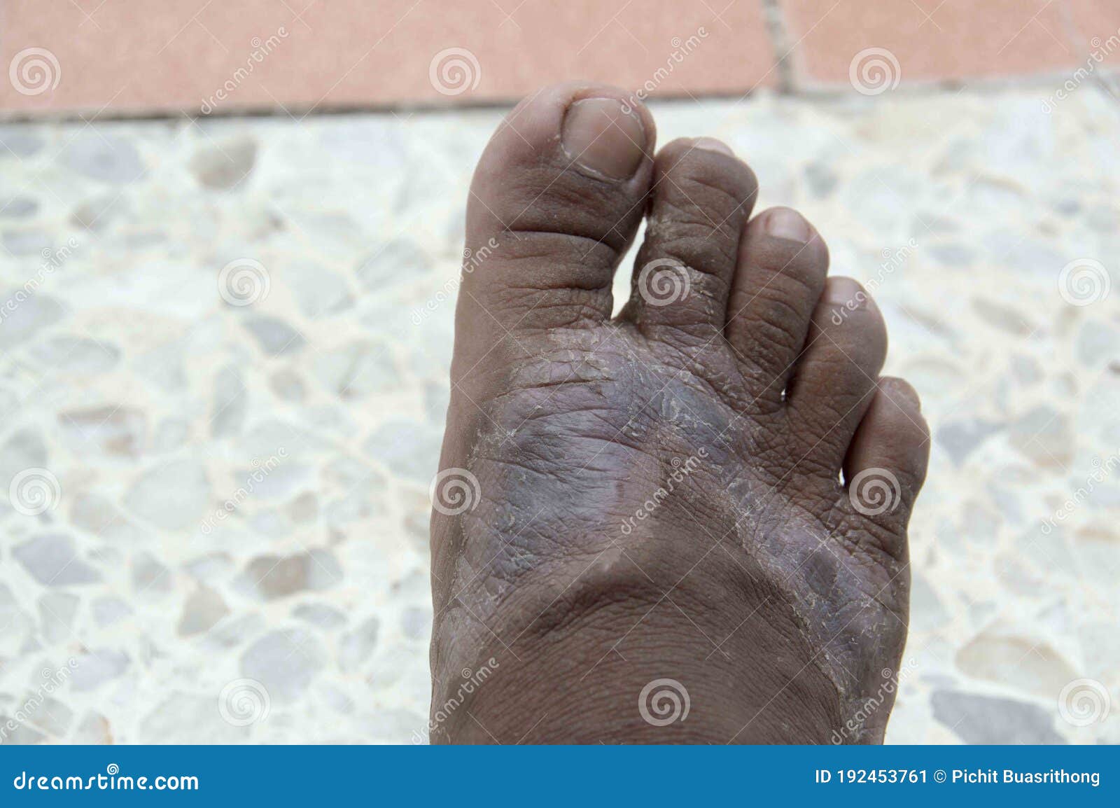 The Right Foot is a Skin Disease Stock Image Image of human, medical