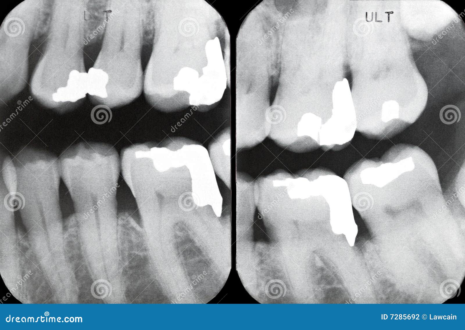 Right Periodontal Xrays Stock Photography Image 7285692