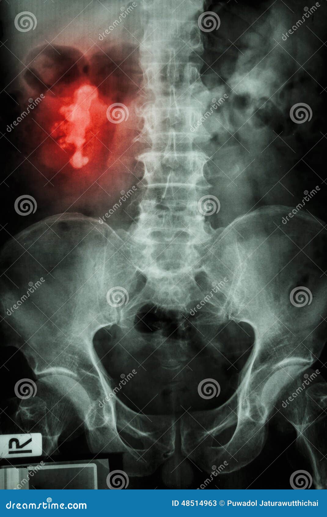 staghorn calculus medical term staghorn calculus medical term