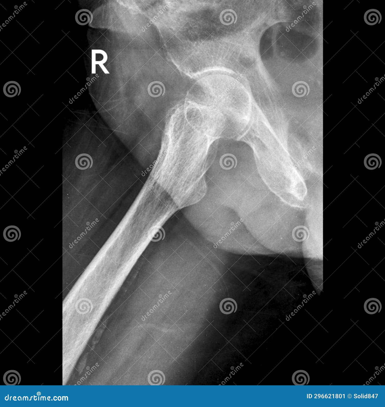 Hip Joint X-ray Image Lateral View Stock Image - Image of lateral ...