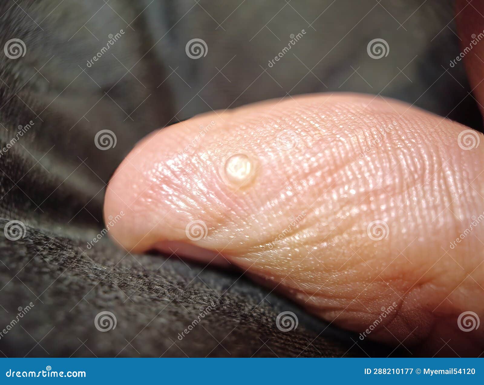 Zoomedin View the Intricacies of a Distinct Thumb Wart Stock Image