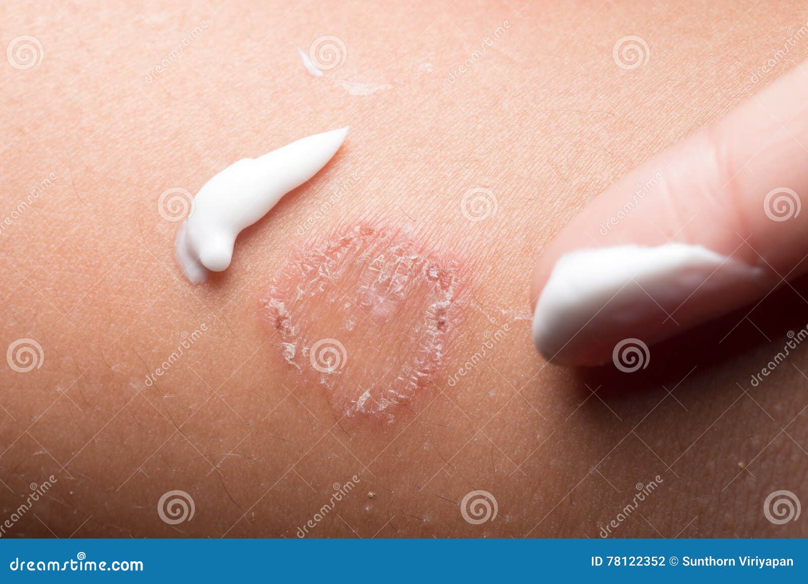 Ring Worm Infection, Dermatophytosis Stock Photo Image of erysipelas
