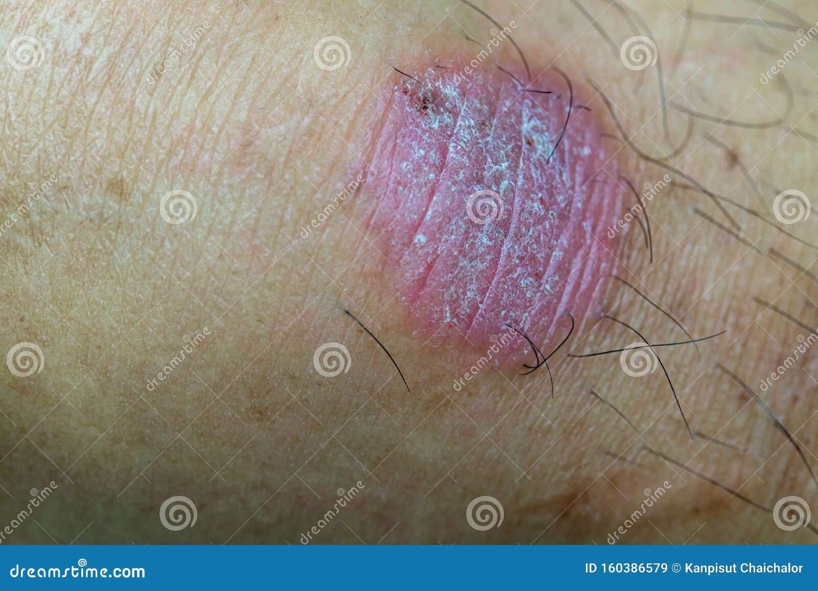 Ring Worm Infection, Dermatophytosis on Skin. Ringworm Infection or Tinea  on Skin. Mycosis Infection on the Human Skin Stock Image - Image of  allergic, injury: 160386579