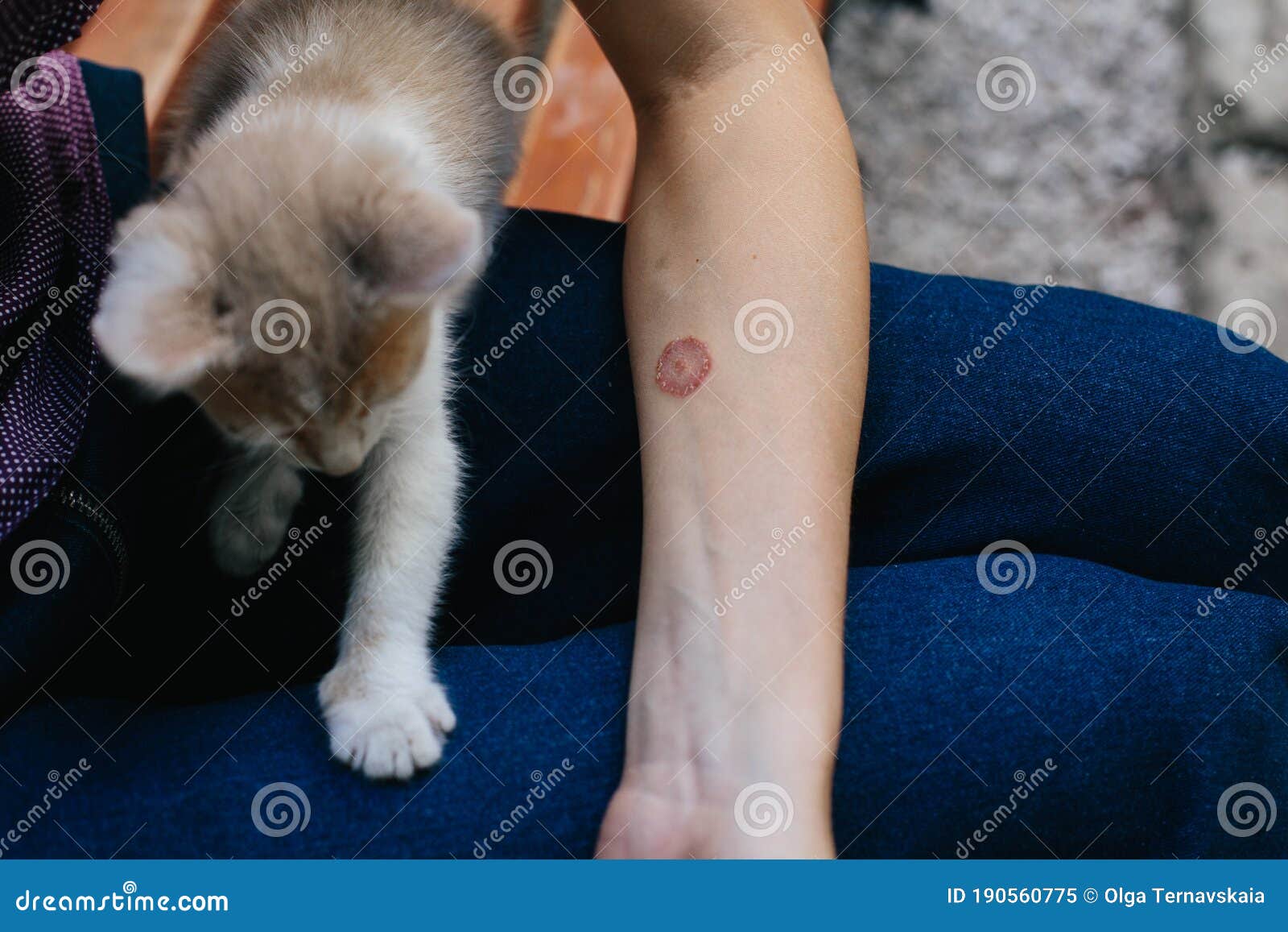 Ringworm on Arm with Hand. Cat Disease. Skin Problem Stock Image