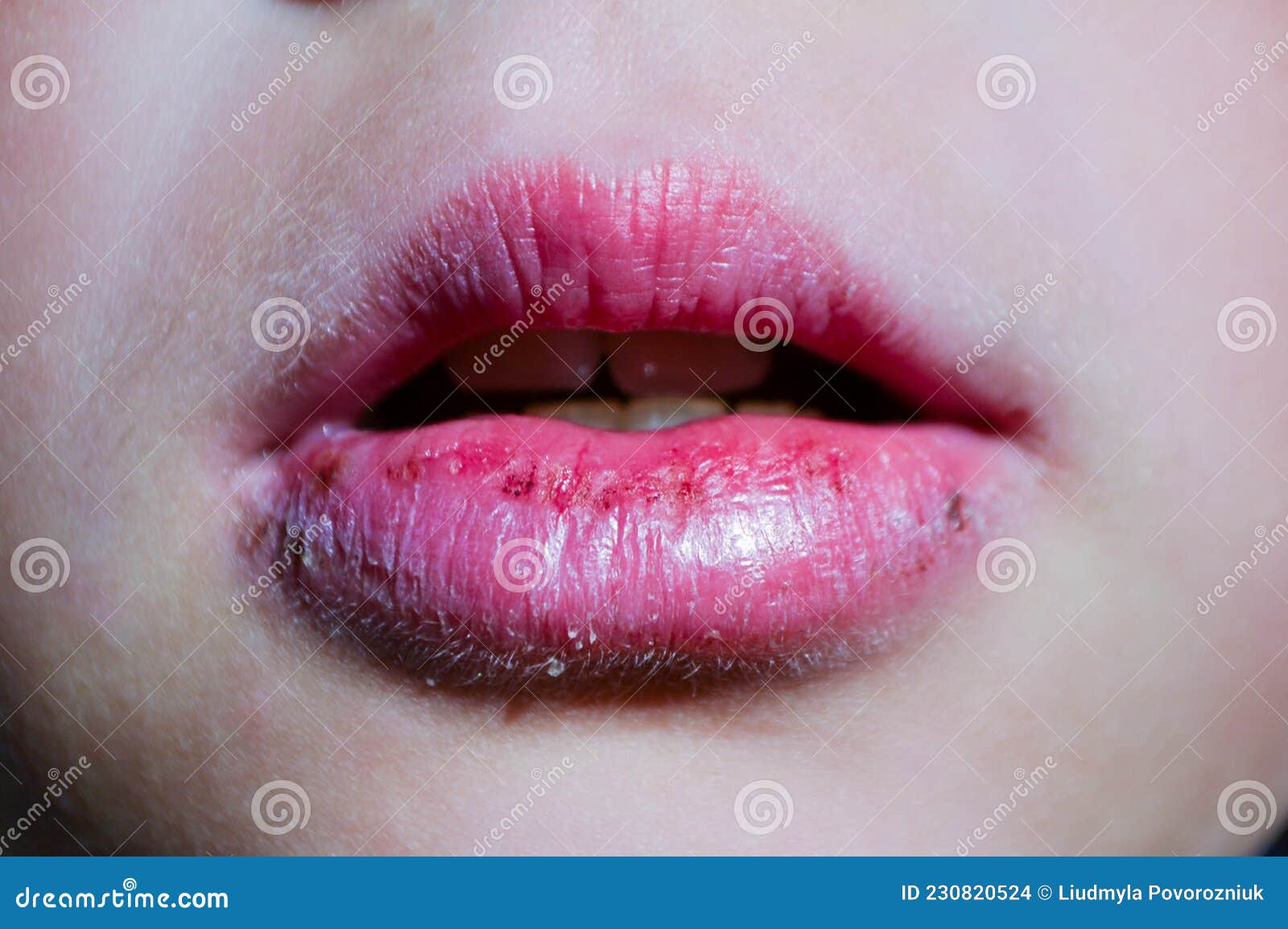 Risse Der Lippen Verursachten Wunden an Den Ecken, Hautprobleme Mit