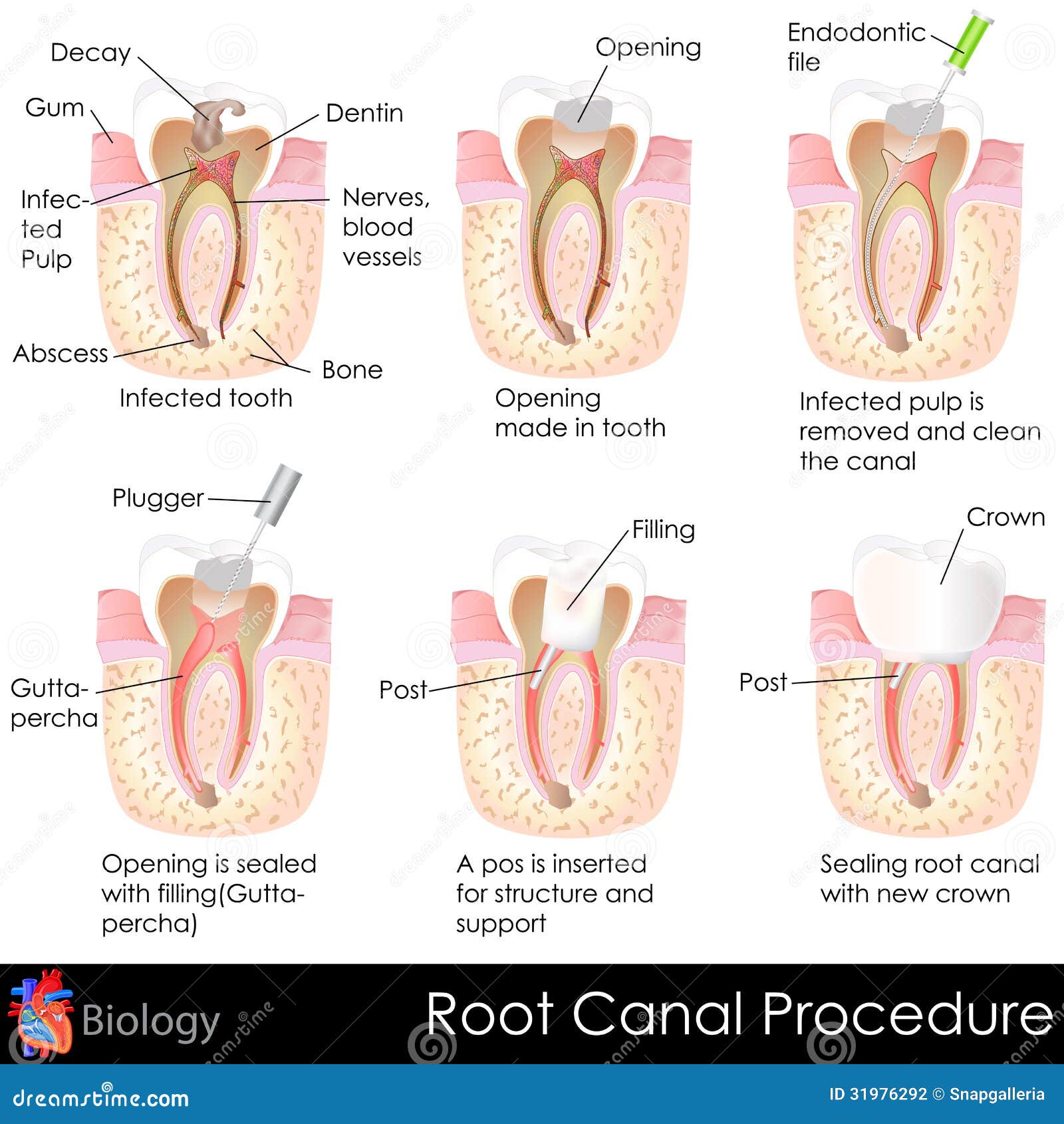 root canal procedure