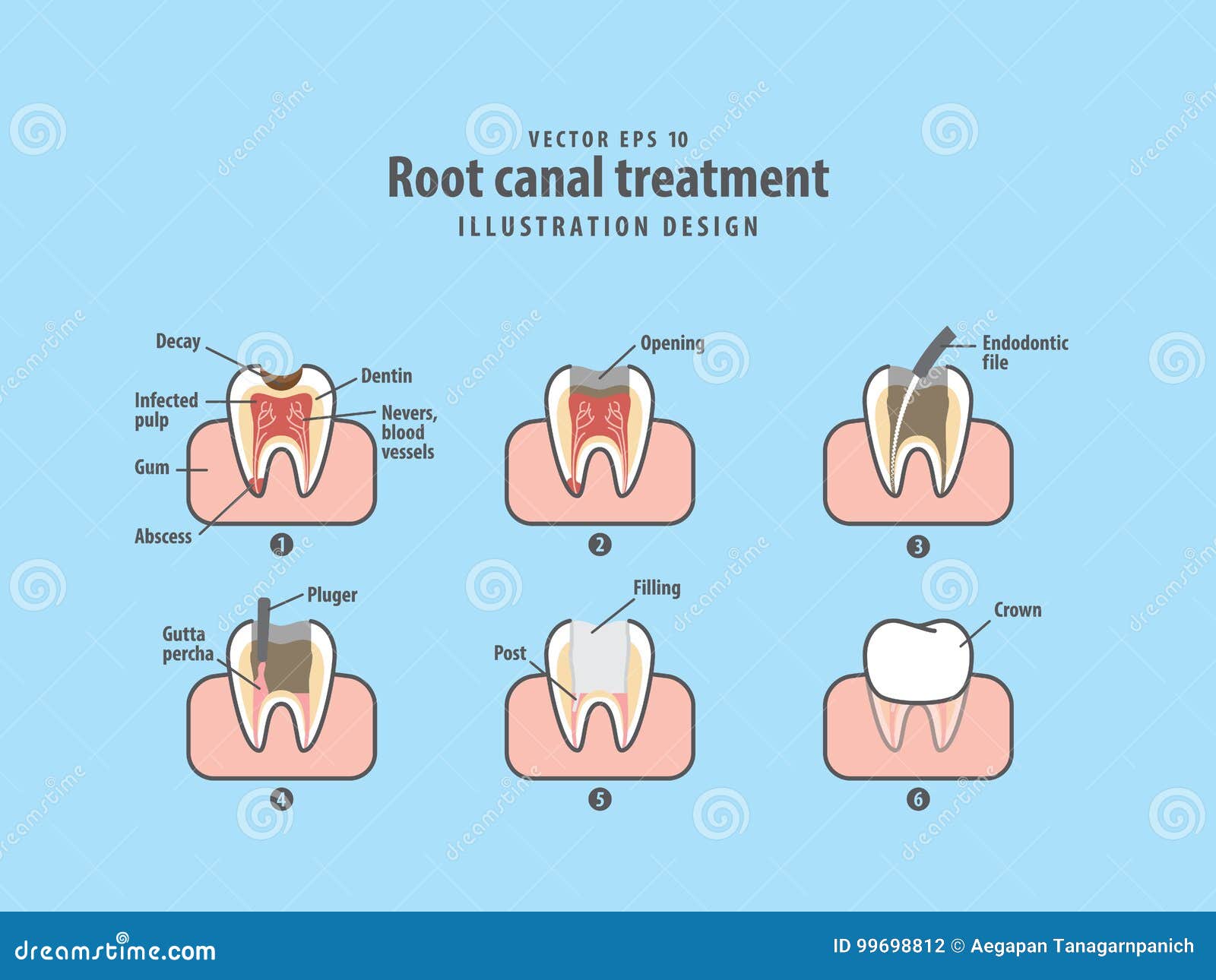 root canal treatment   on blue background.
