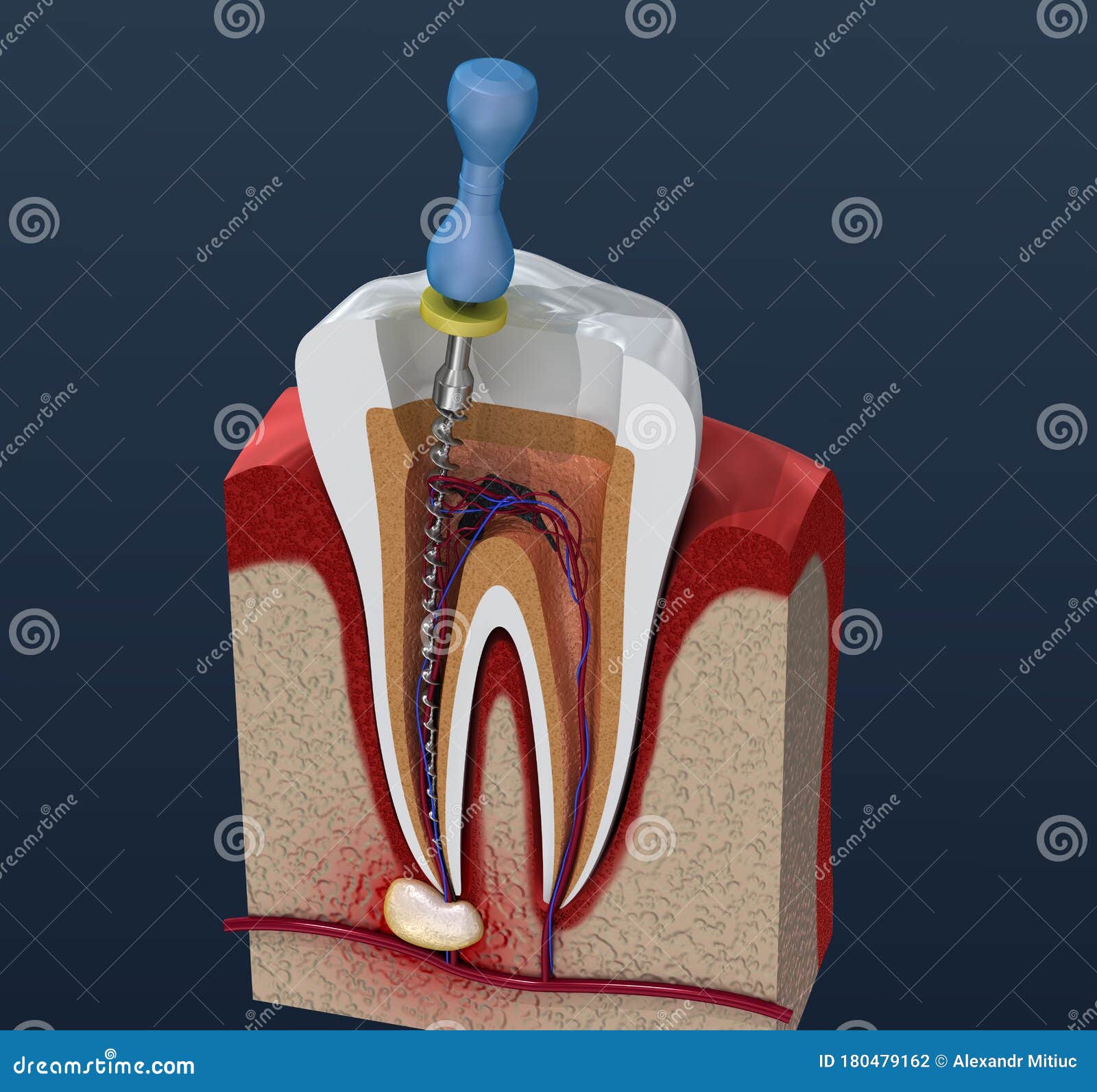 root canal treatment process. 