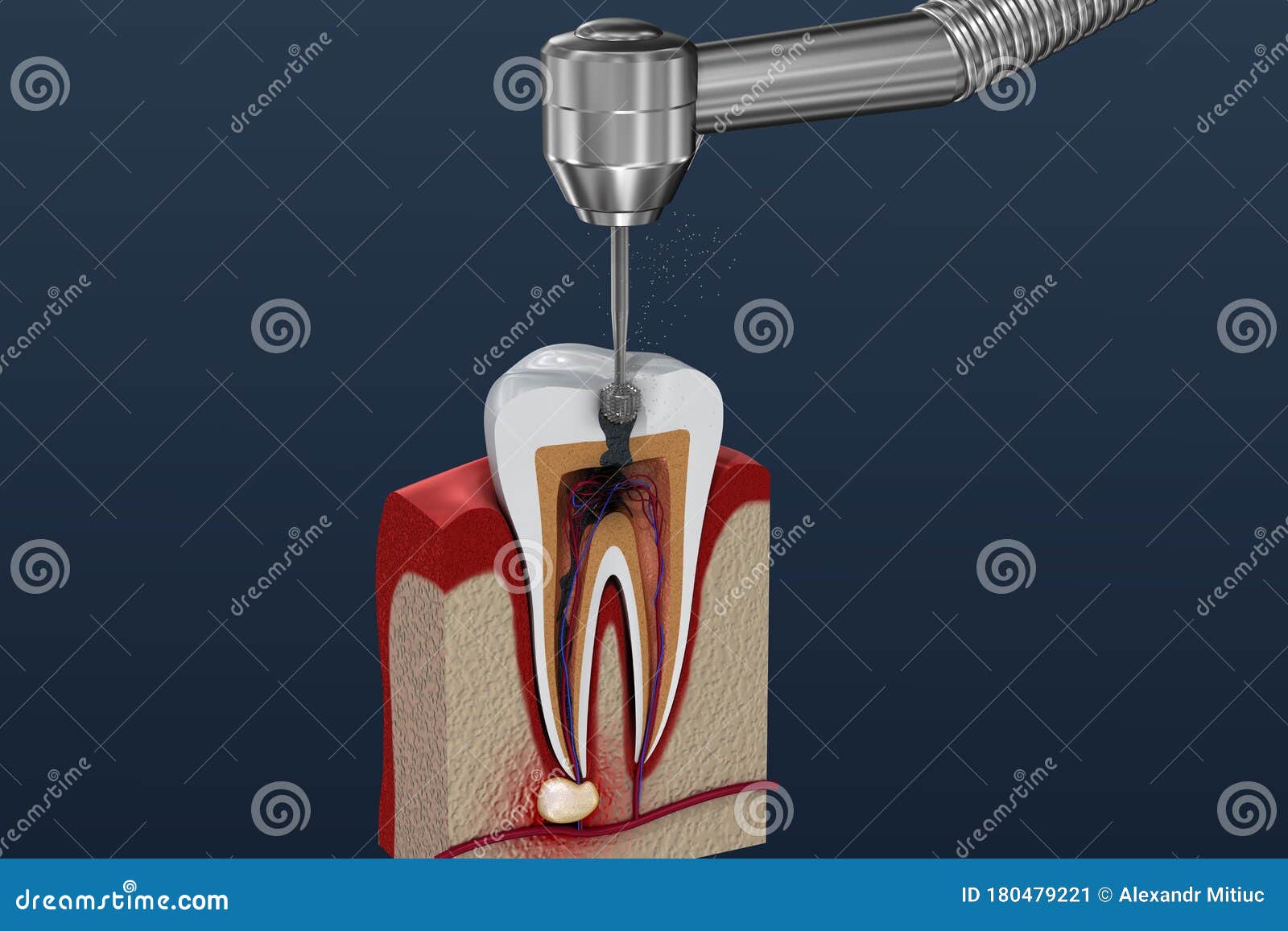 root canal treatment process. 