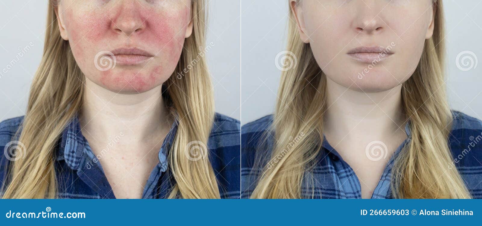 Rosacea Face The Girl Suffers From Redness On Her Cheeks Couperosis