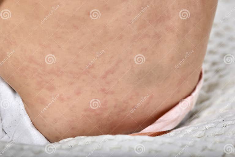 Roseola Rash a Viral Rash on the Skin of a Child Stock Image Image of