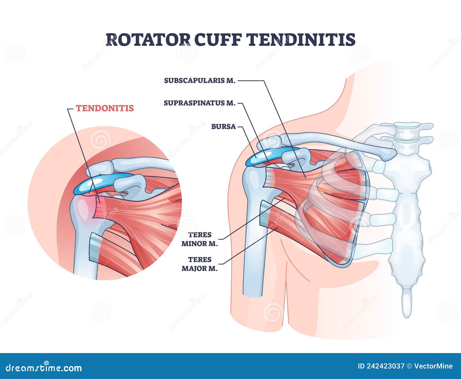 rotator cuff tendinitis as shoulder muscular inflammation outline diagram