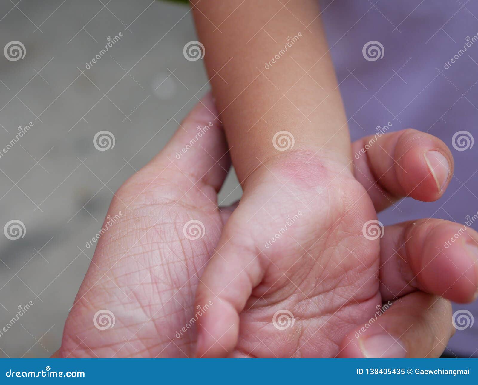 Rougeur Demangeant Et Gonflant Apres Une Morsure De Moustique Sur D Un Petit Le Poignet Bebe Allergie A La Salive De Moustiqu Image Stock Image Du Gosse Skeeter