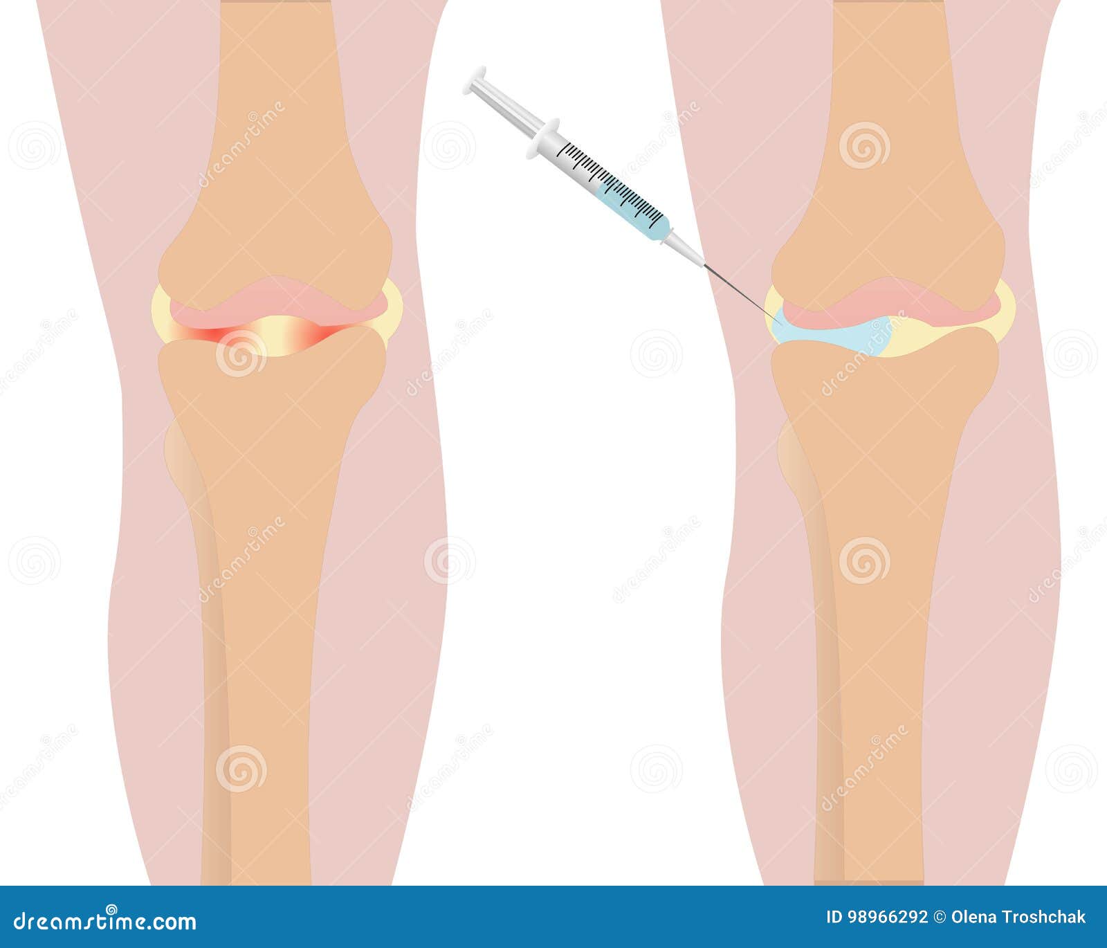 Rougeur D'inflammation D'injection De Genou Illustration de ...