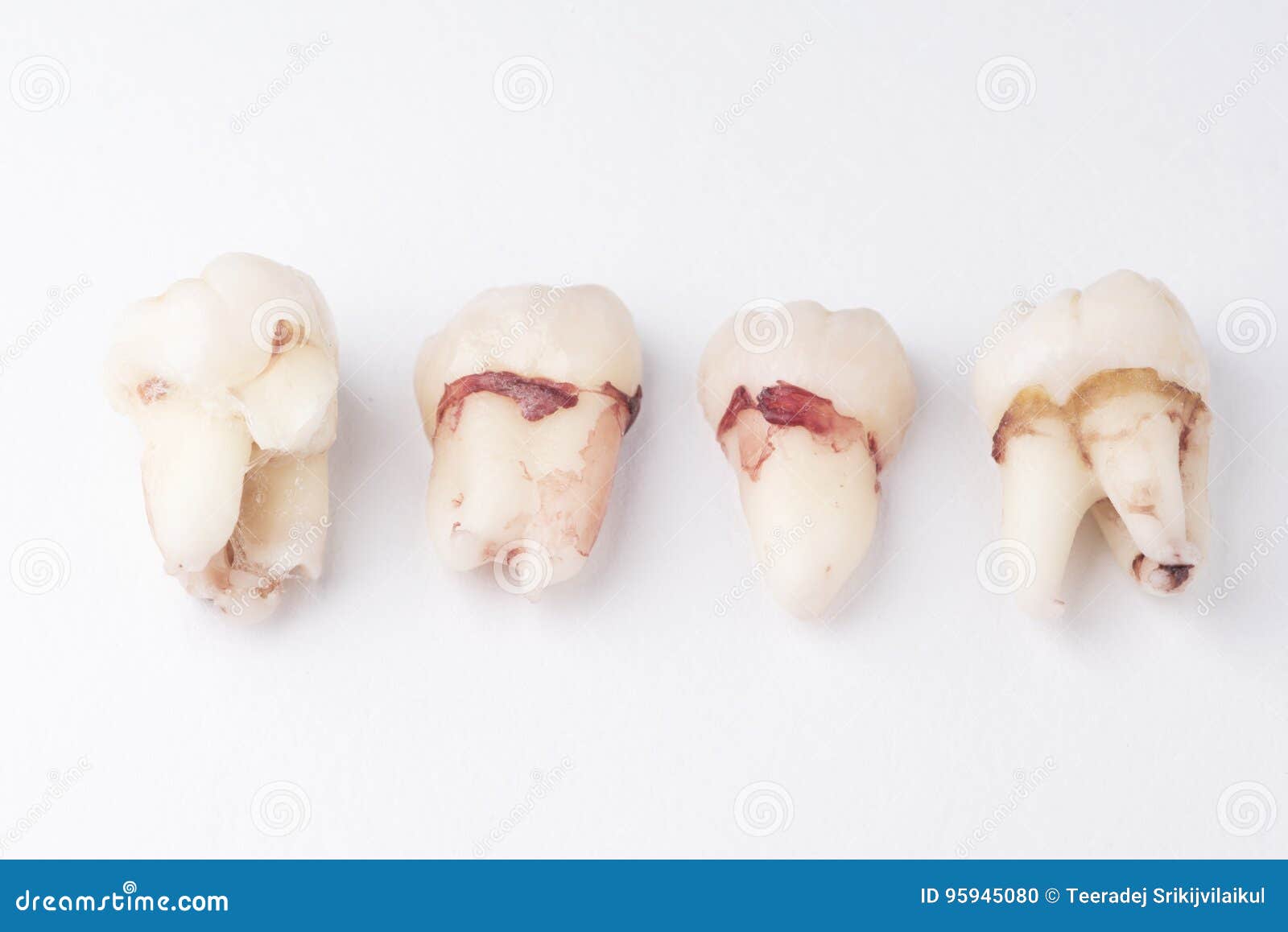 Row of Extracted Wisdom Tooth Stock Photo Image of remove, extracted