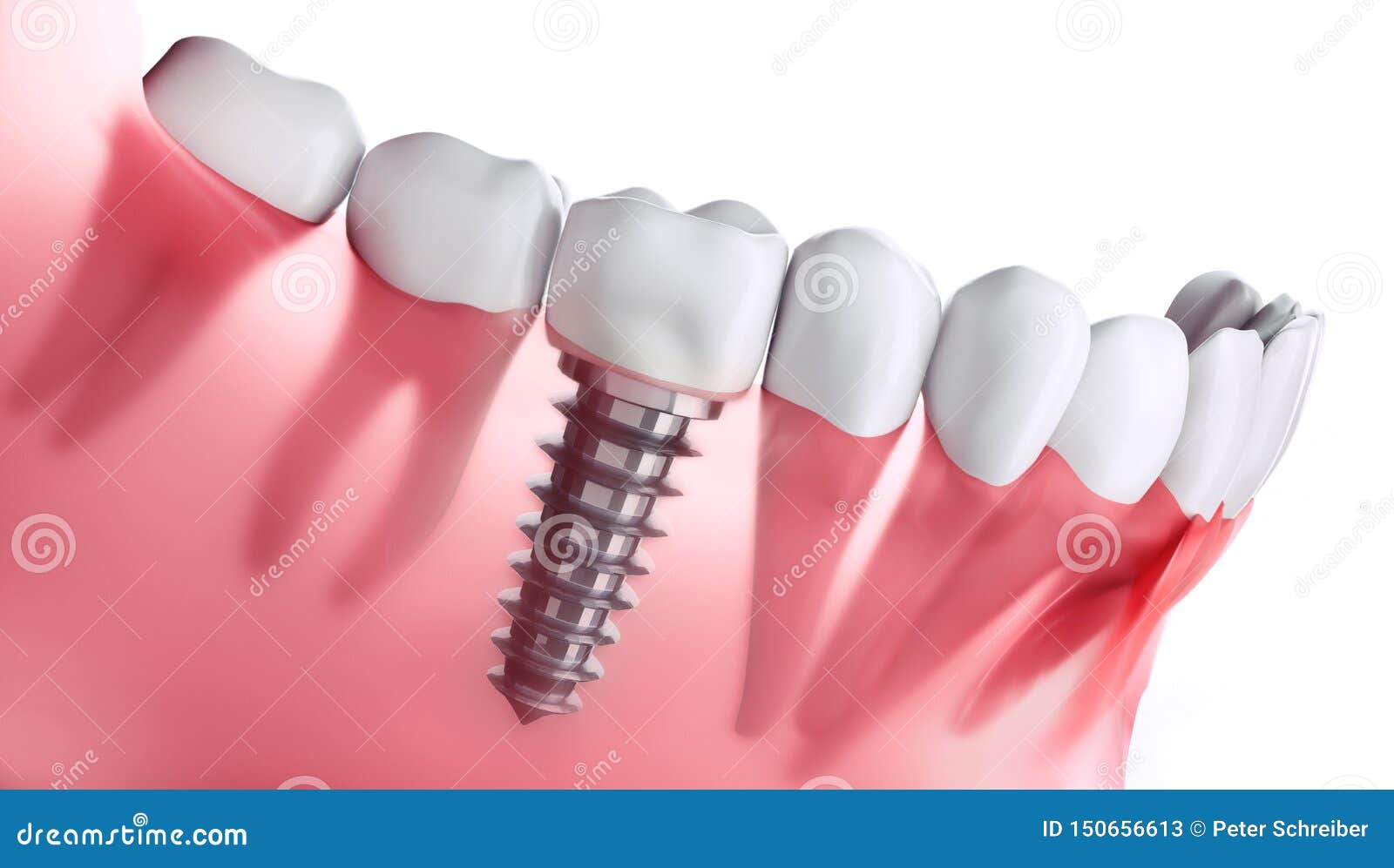 closeup of dental implant in jaw